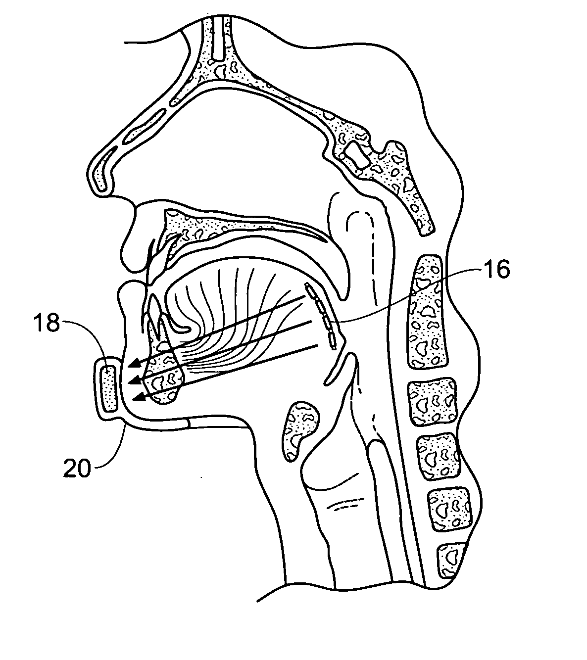 Devices, systems, and methods for stabilization or fixation of magnetic force devices used in or on a body