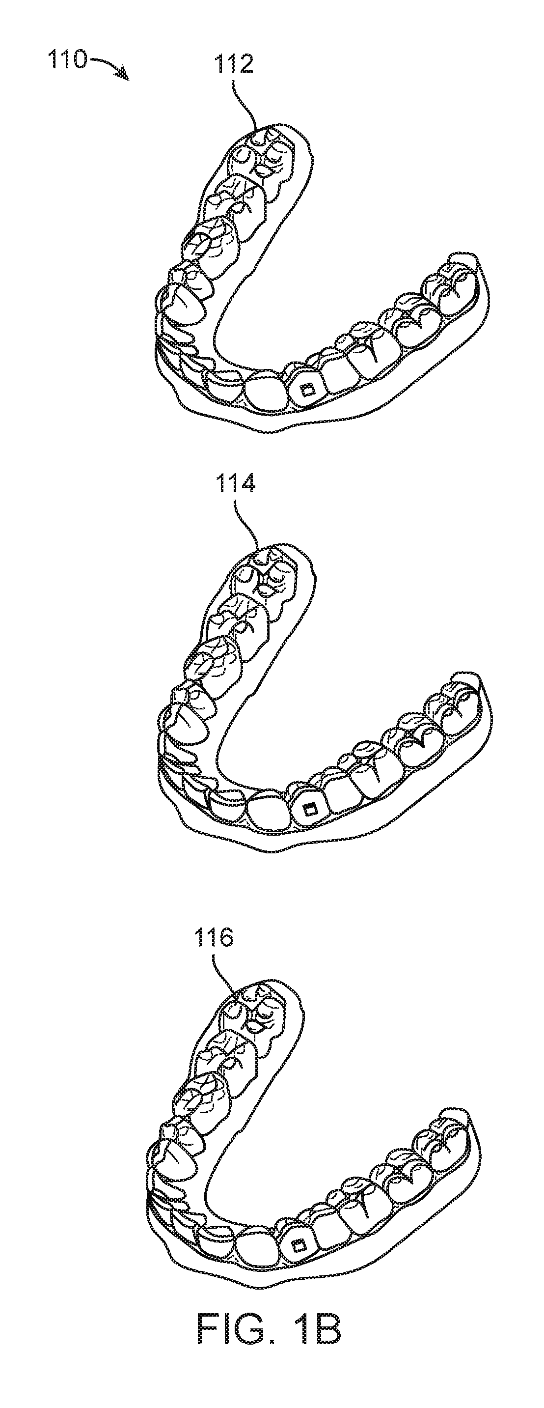 Direct fabrication of aligners for arch expansion