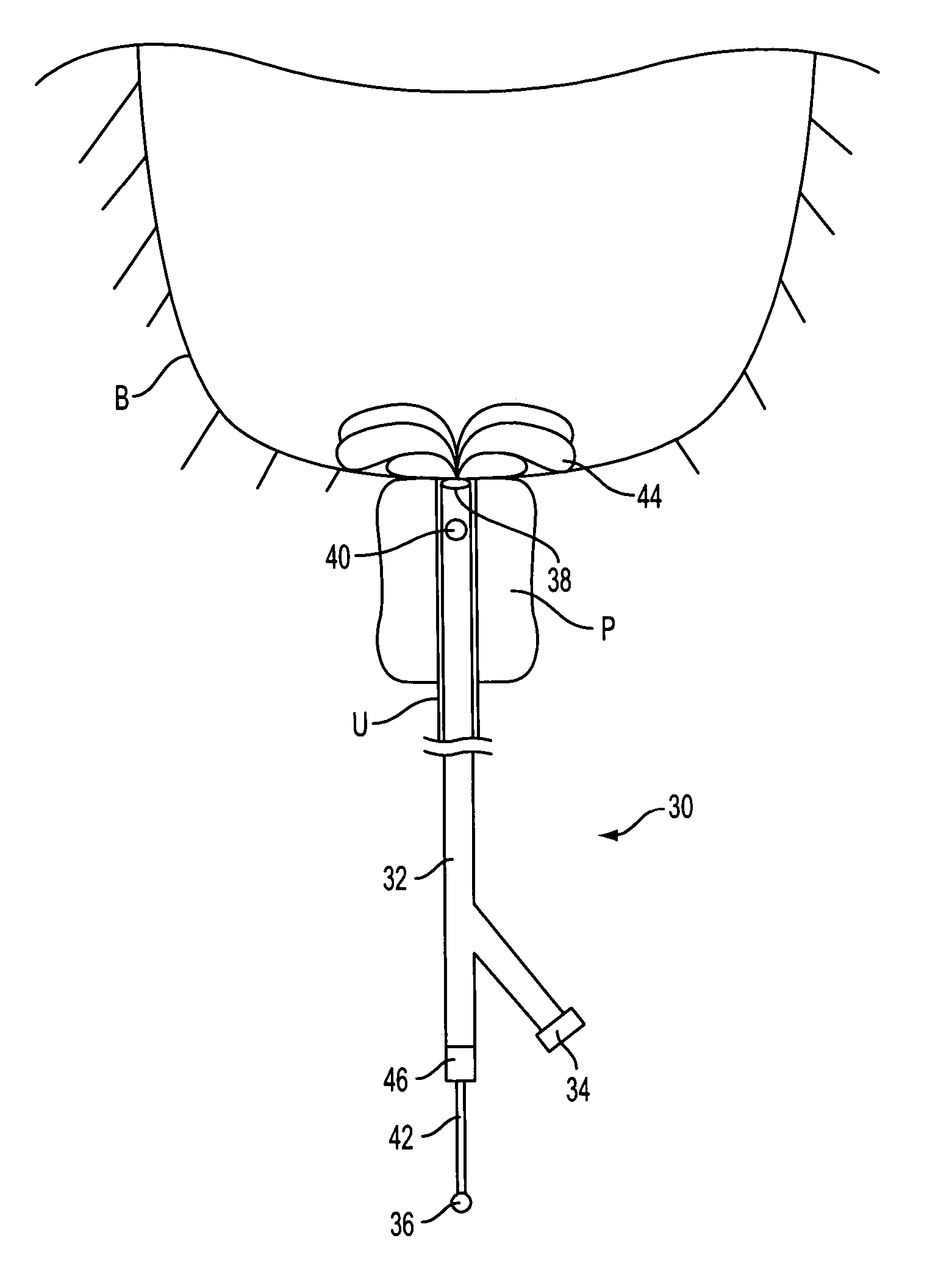Prostate visualization device and methods of use