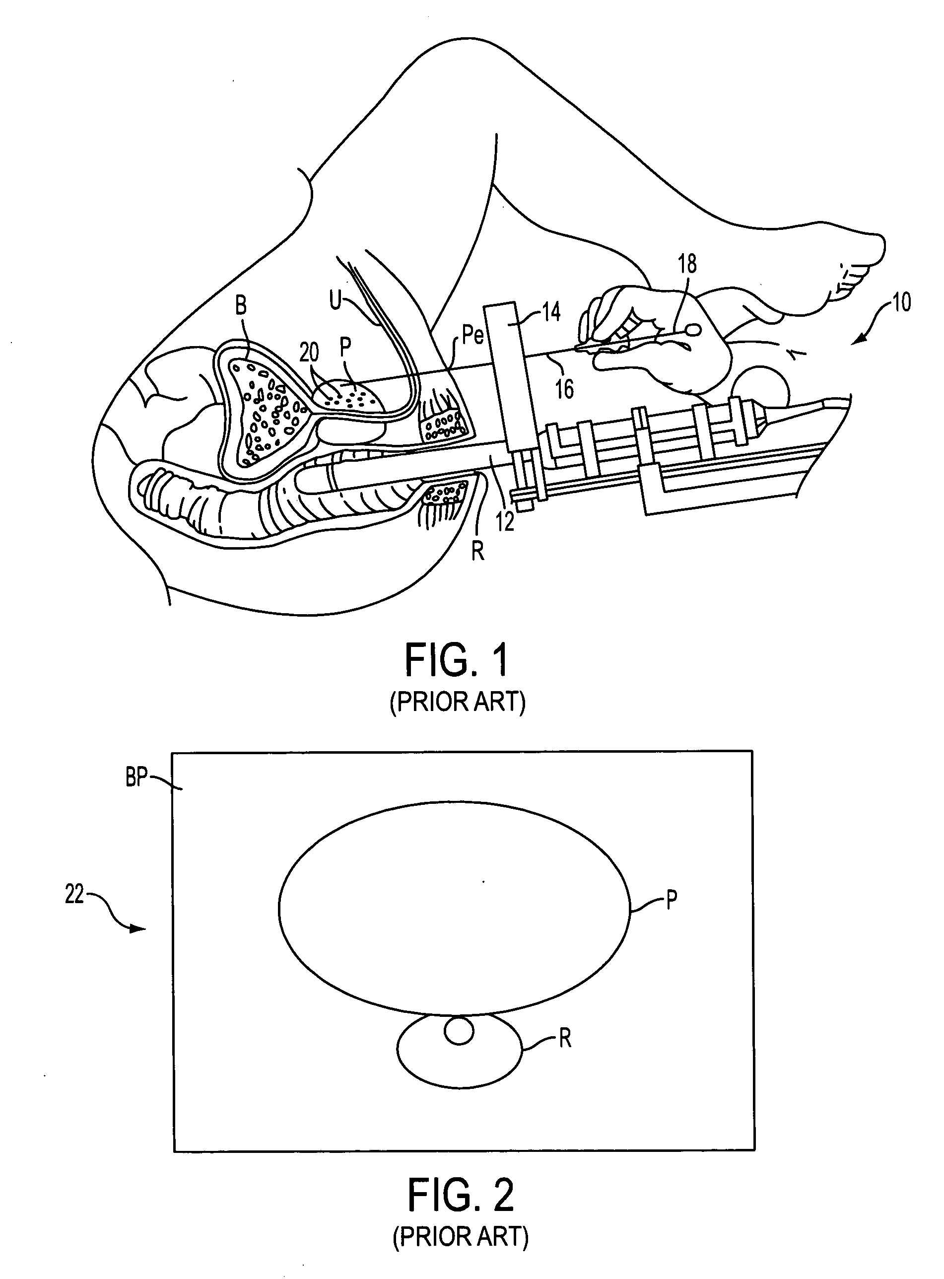 Prostate visualization device and methods of use