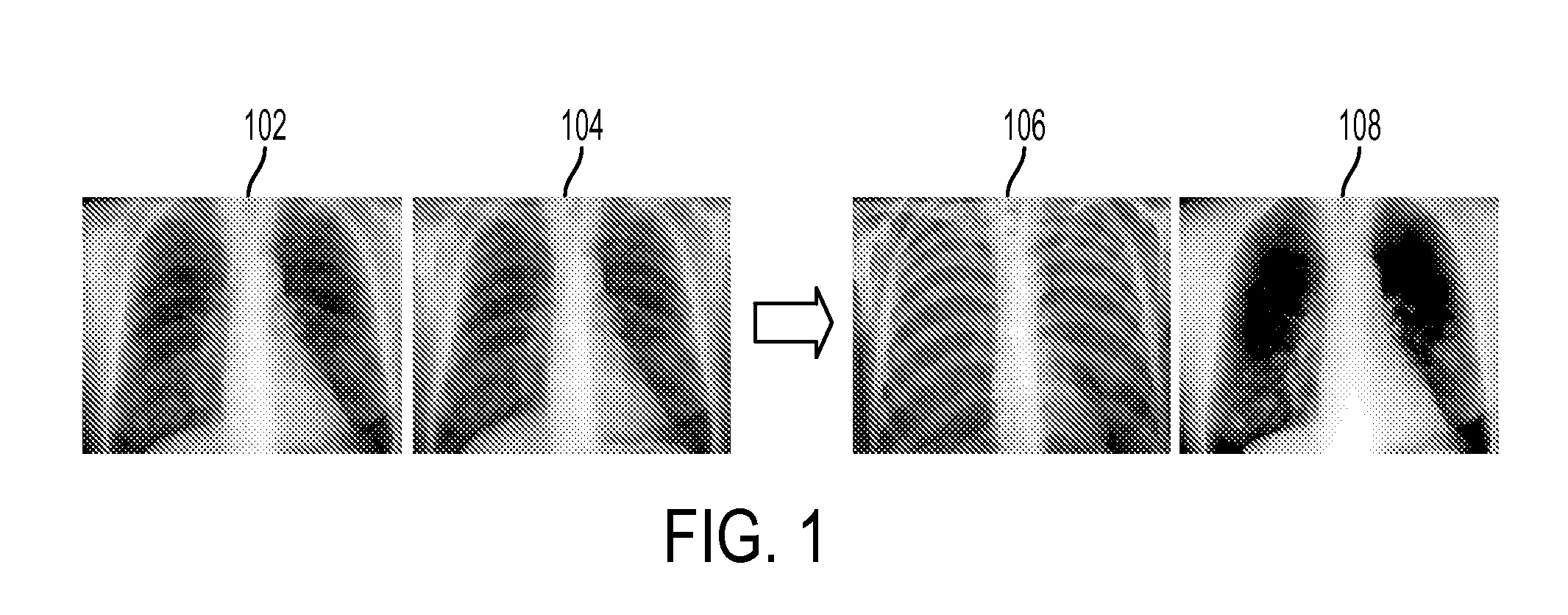 Method and system for bone suppression based on a single x-ray image