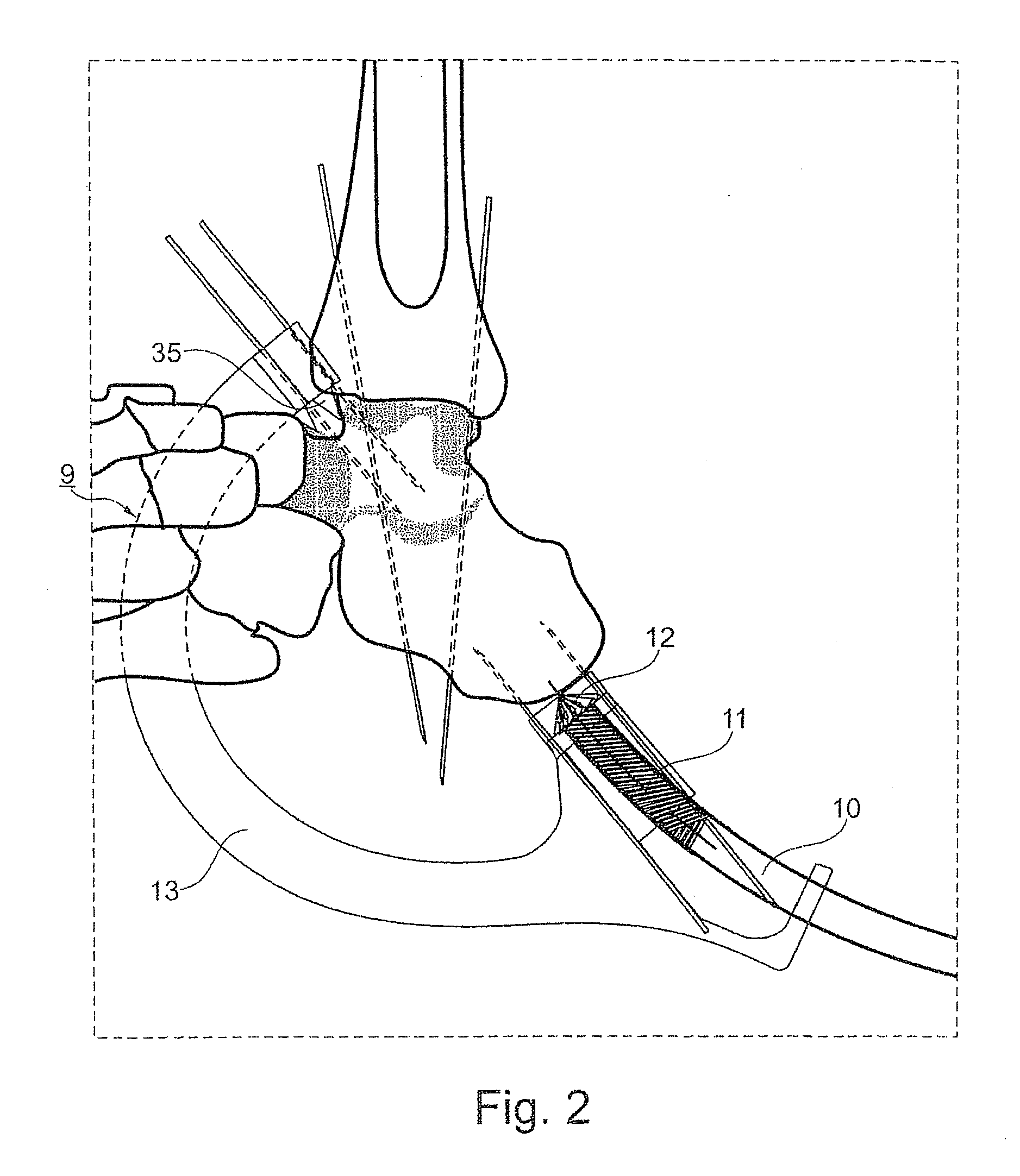 Device for forming a bore to facilitate insertion of an arcuate nail into a bone