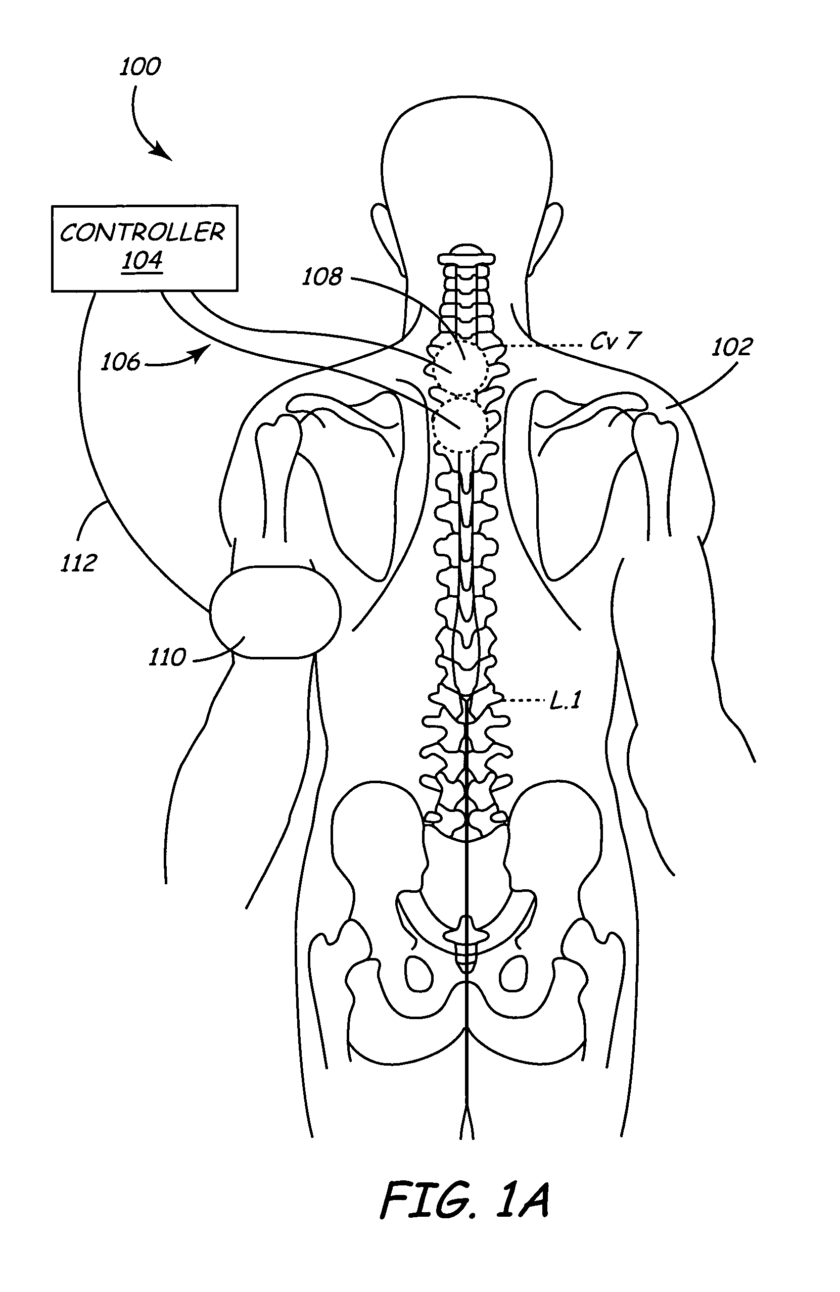 Method and apparatus to minimize effects of a cardiac insult