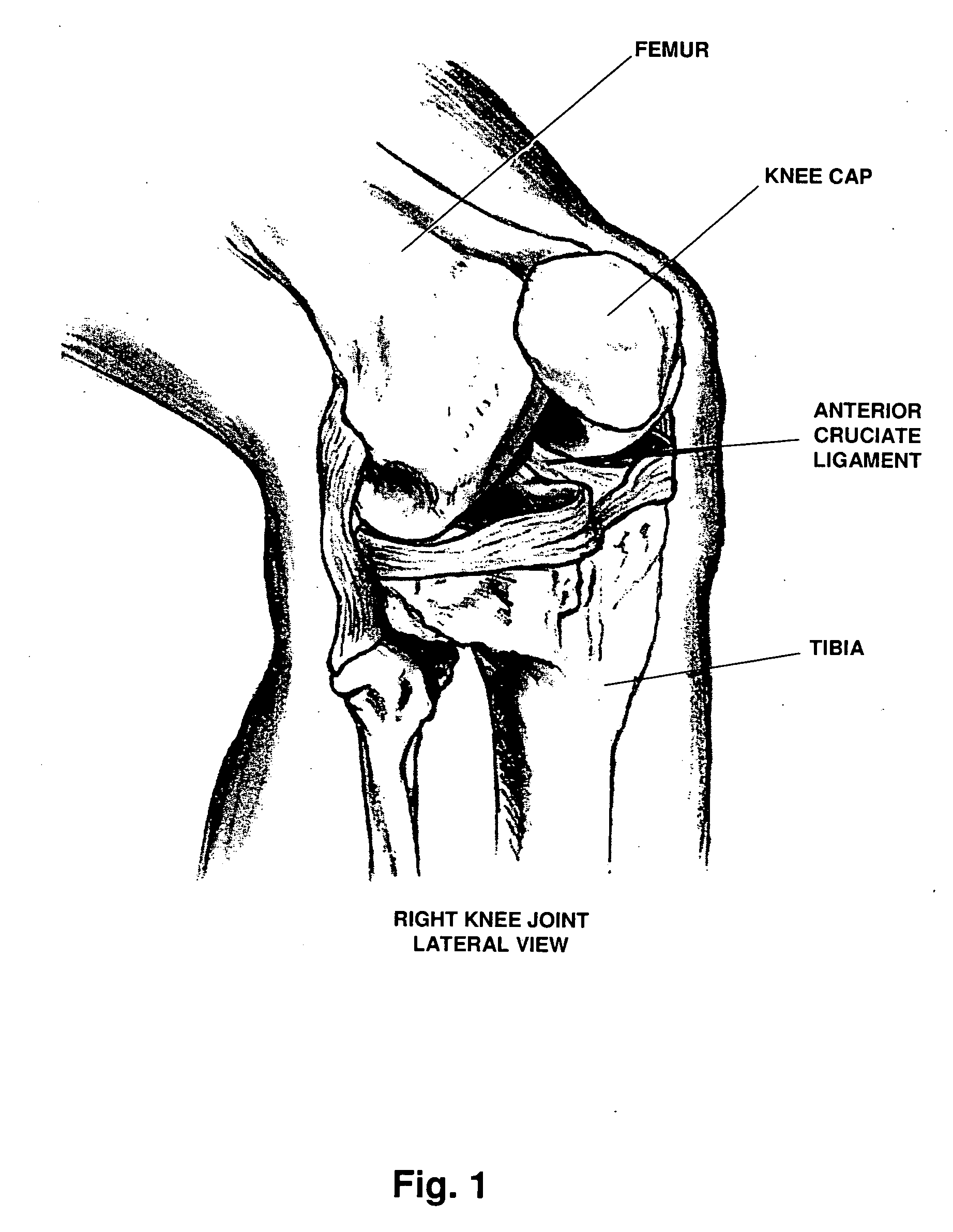 Method for repair and reconstruction of ruptured ligaments or tendons and for treatment of ligament and tendon injuries
