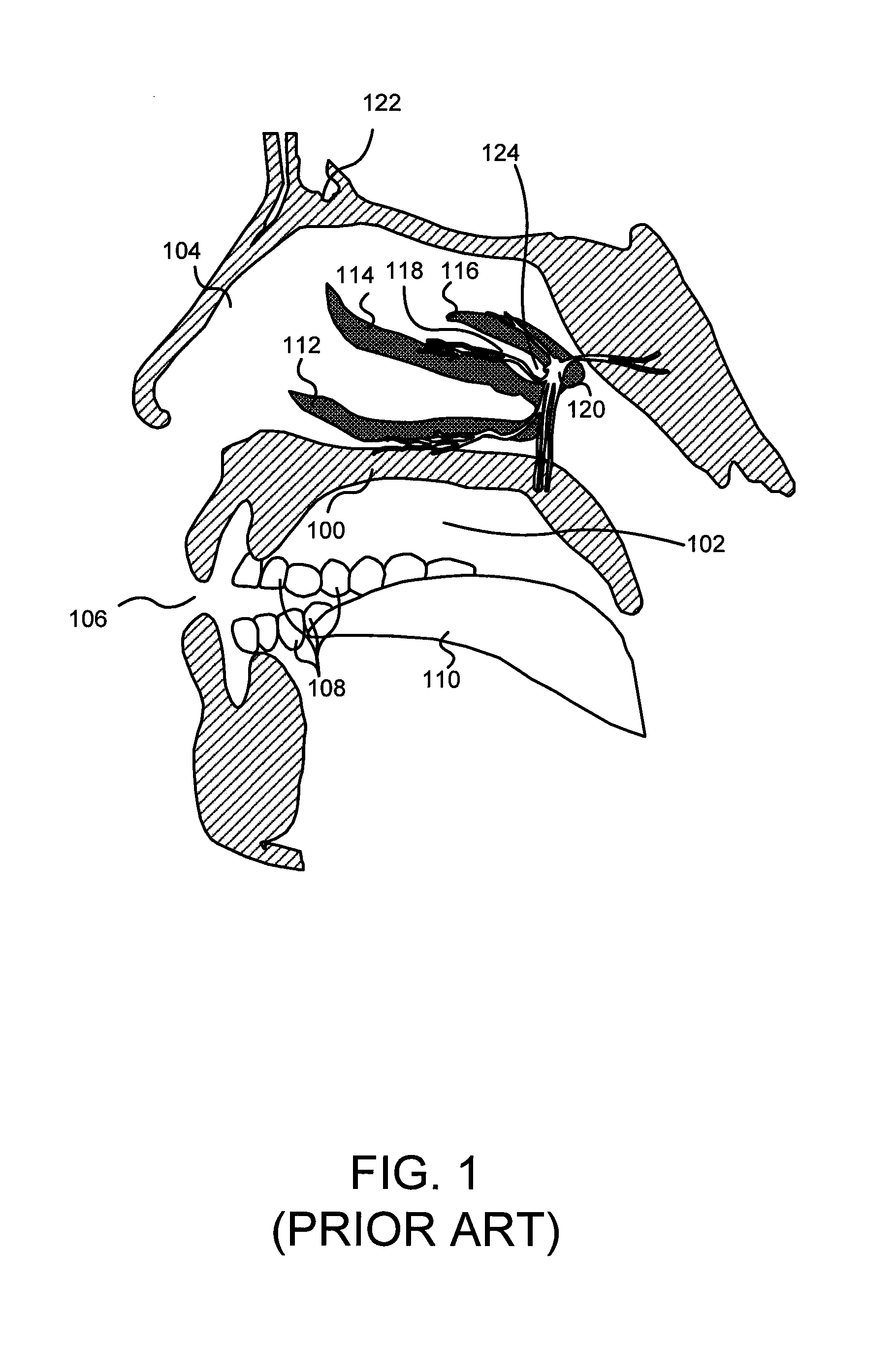 Enhanced systems, processes and apparatus for facilitating intranasal treatment of a patient and products thereby