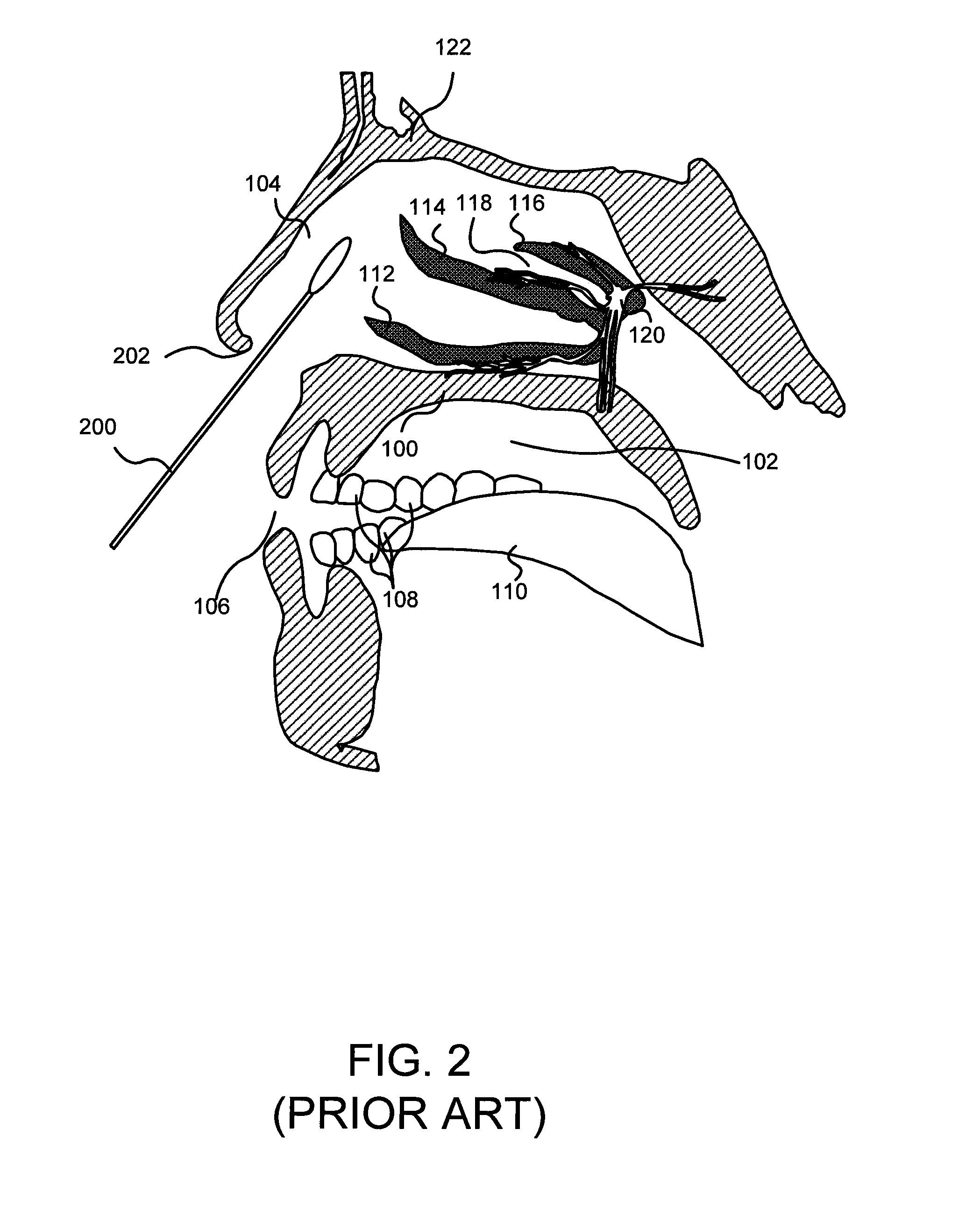 Enhanced systems, processes and apparatus for facilitating intranasal treatment of a patient and products thereby
