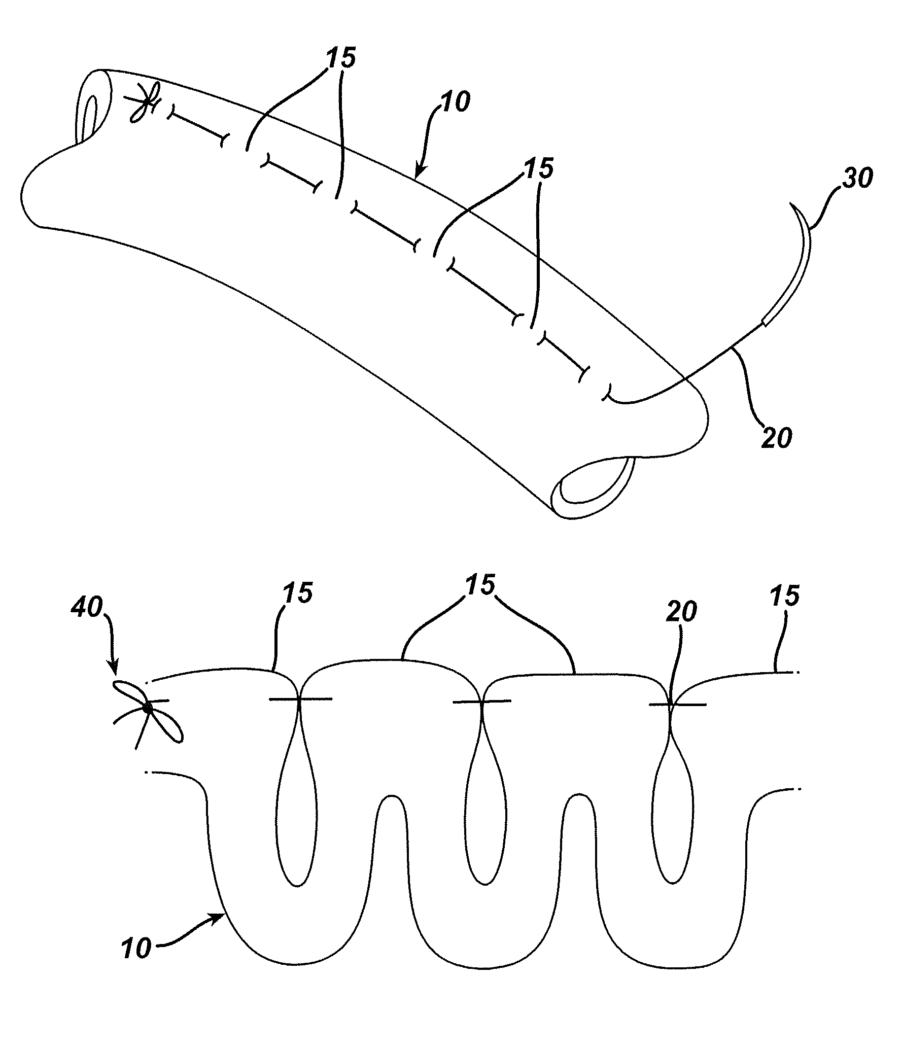 Methods and devices for the rerouting of chyme to induce intestinal brake