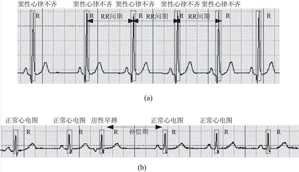 Automatic electrocardiogram recognition system
