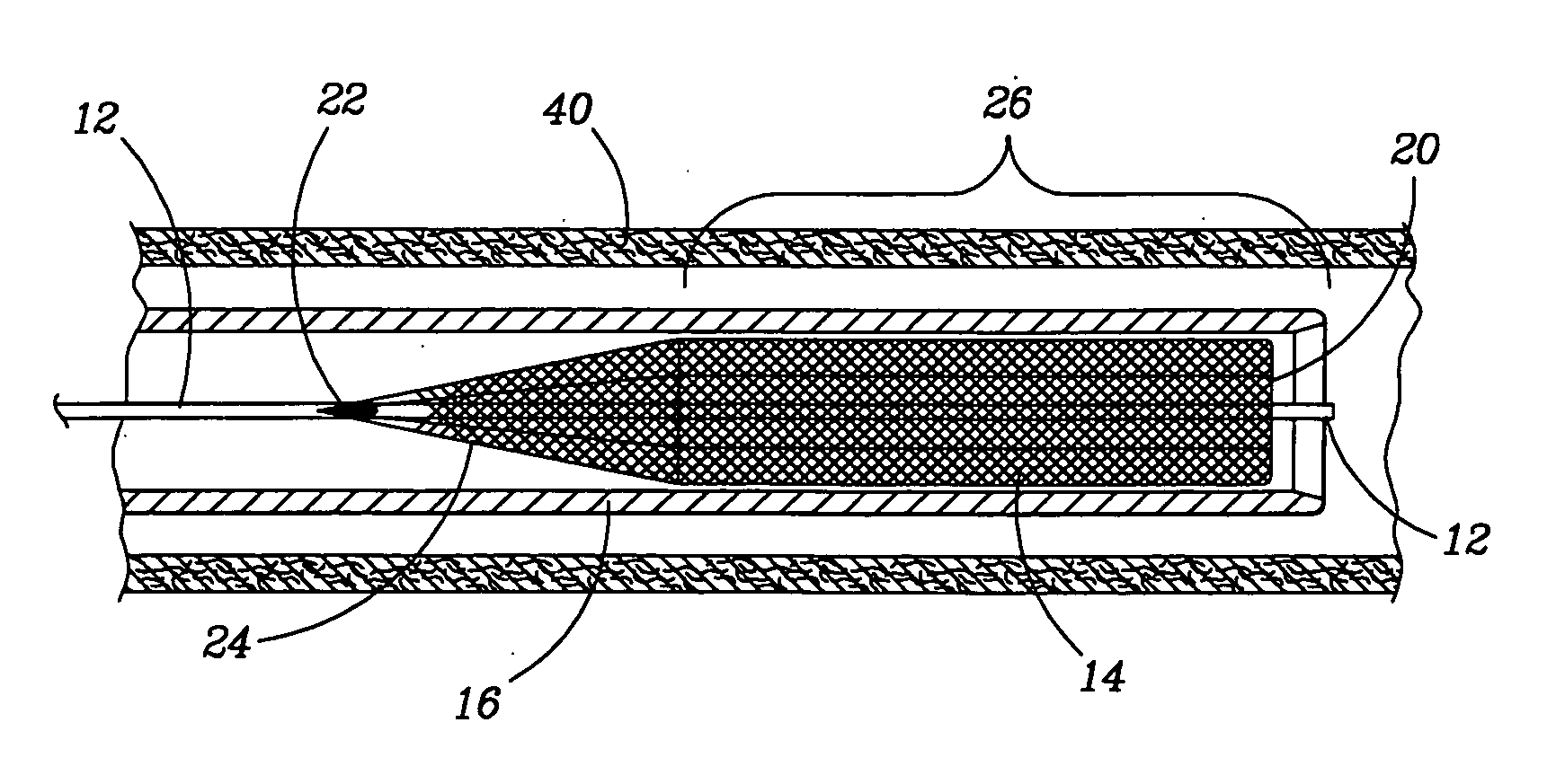 Retractable flow maintaining stent wire