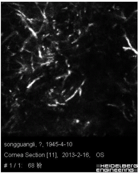 Fungal keratitis image identification method based on AMBP improved algorithm
