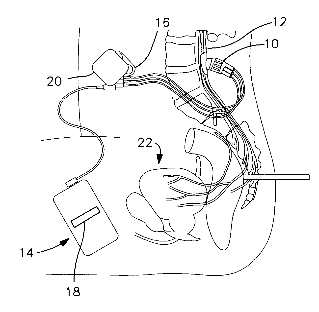 Laparoscopic implantation of neurostimulators