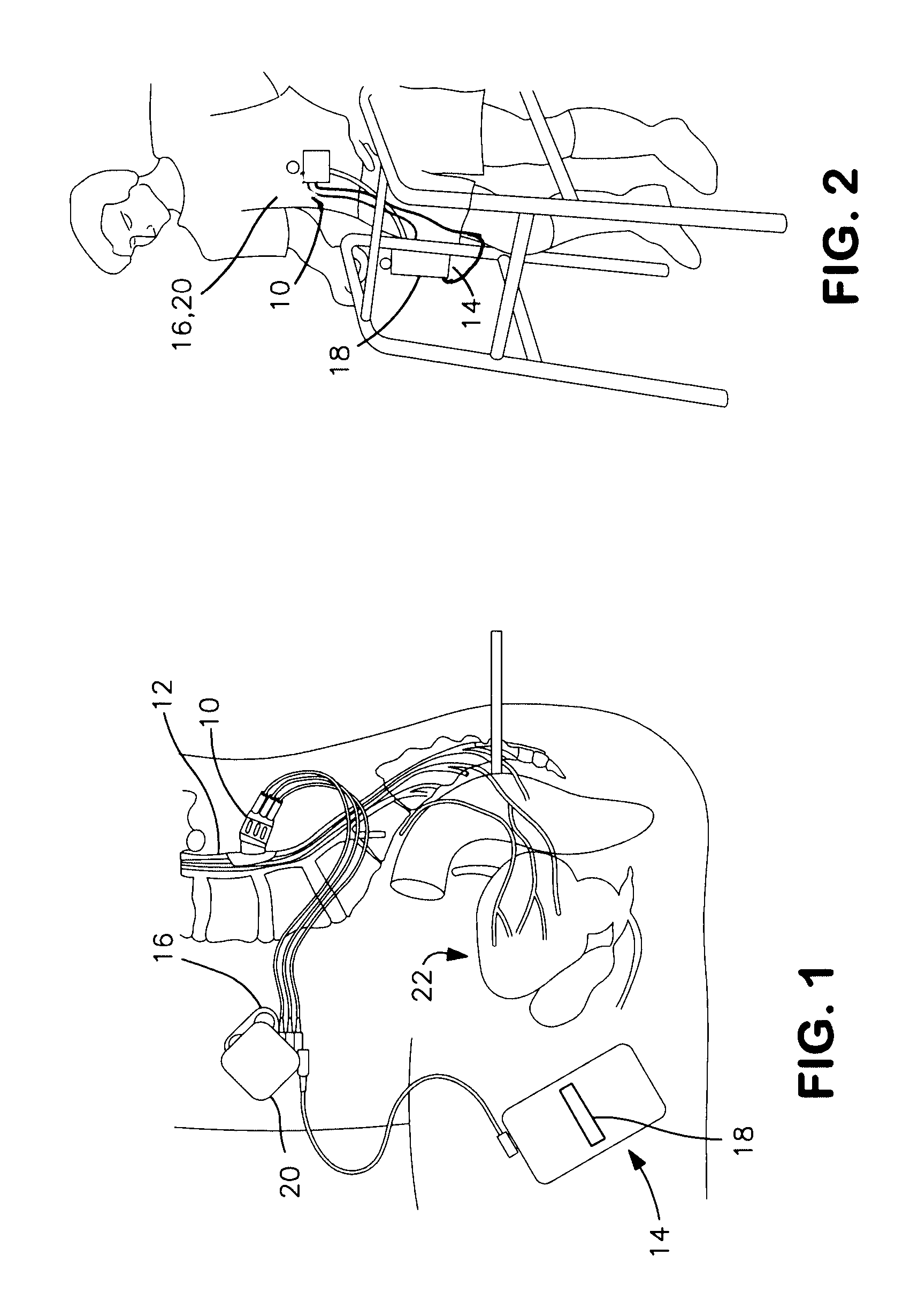 Laparoscopic implantation of neurostimulators