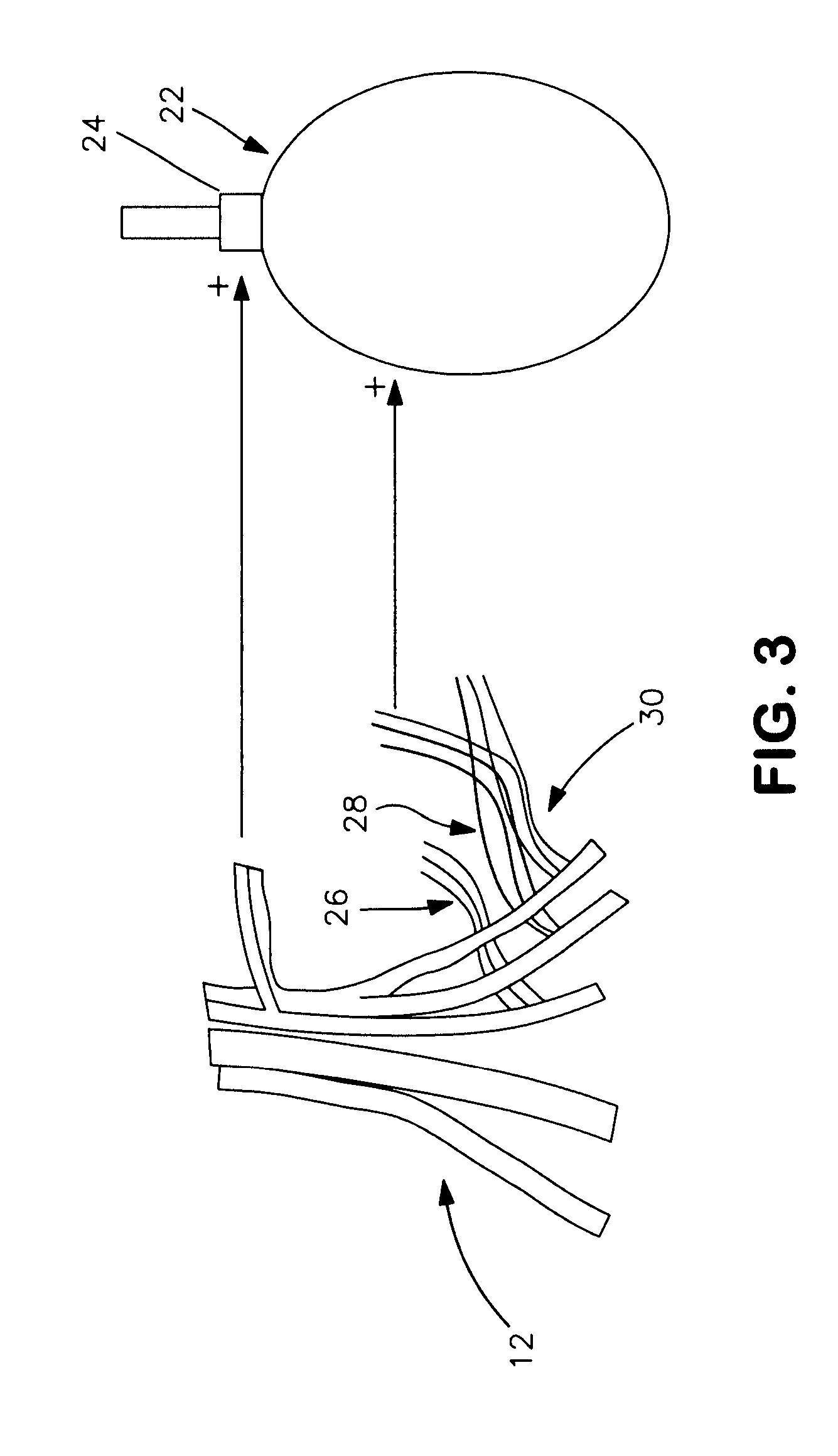 Laparoscopic implantation of neurostimulators