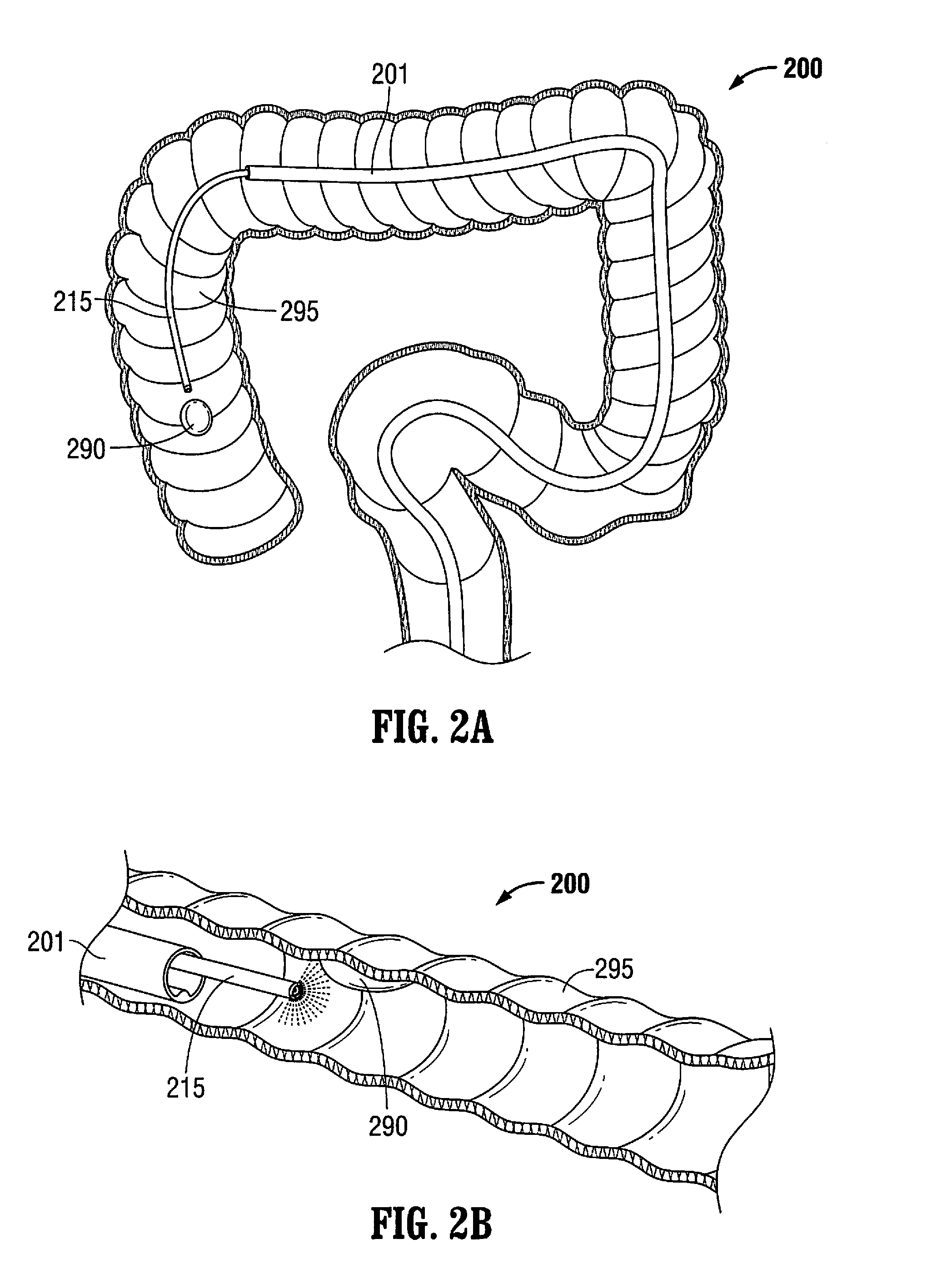 System for a minimally-invasive, operative gastrointestinal treatment