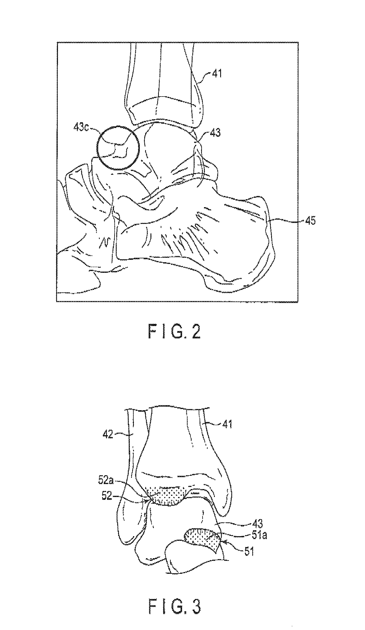 Arthroscopic surgery method for ankle impingement