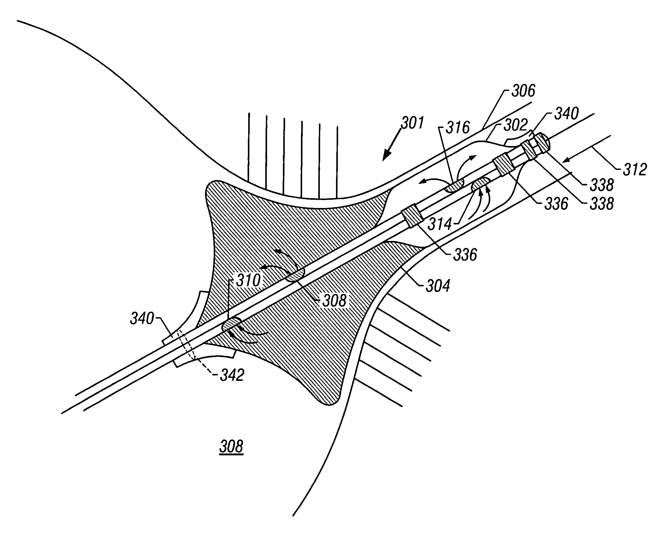Method and device for performing cooling- or cryo-therapies for, e.g., angioplasty with reduced restenosis or pulmonary vein cell necrosis to inhibit atrial fibrillation employing microporous balloon