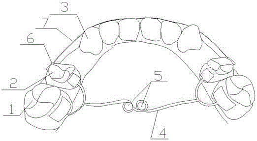 Device for closing tooth-extraction gap of upper jaw