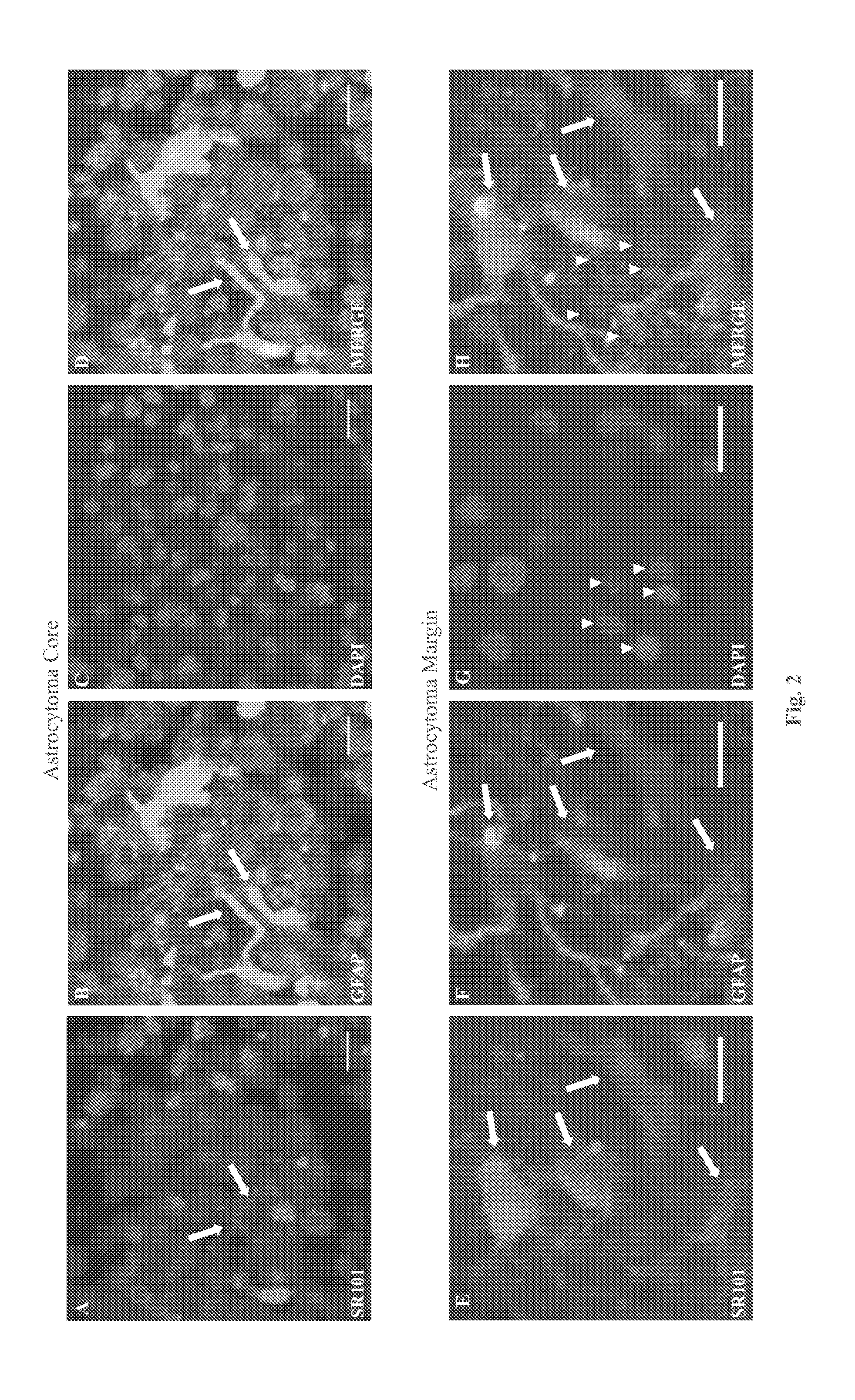 System and Method for Diagnosis of Astrocytic Brain Tumor