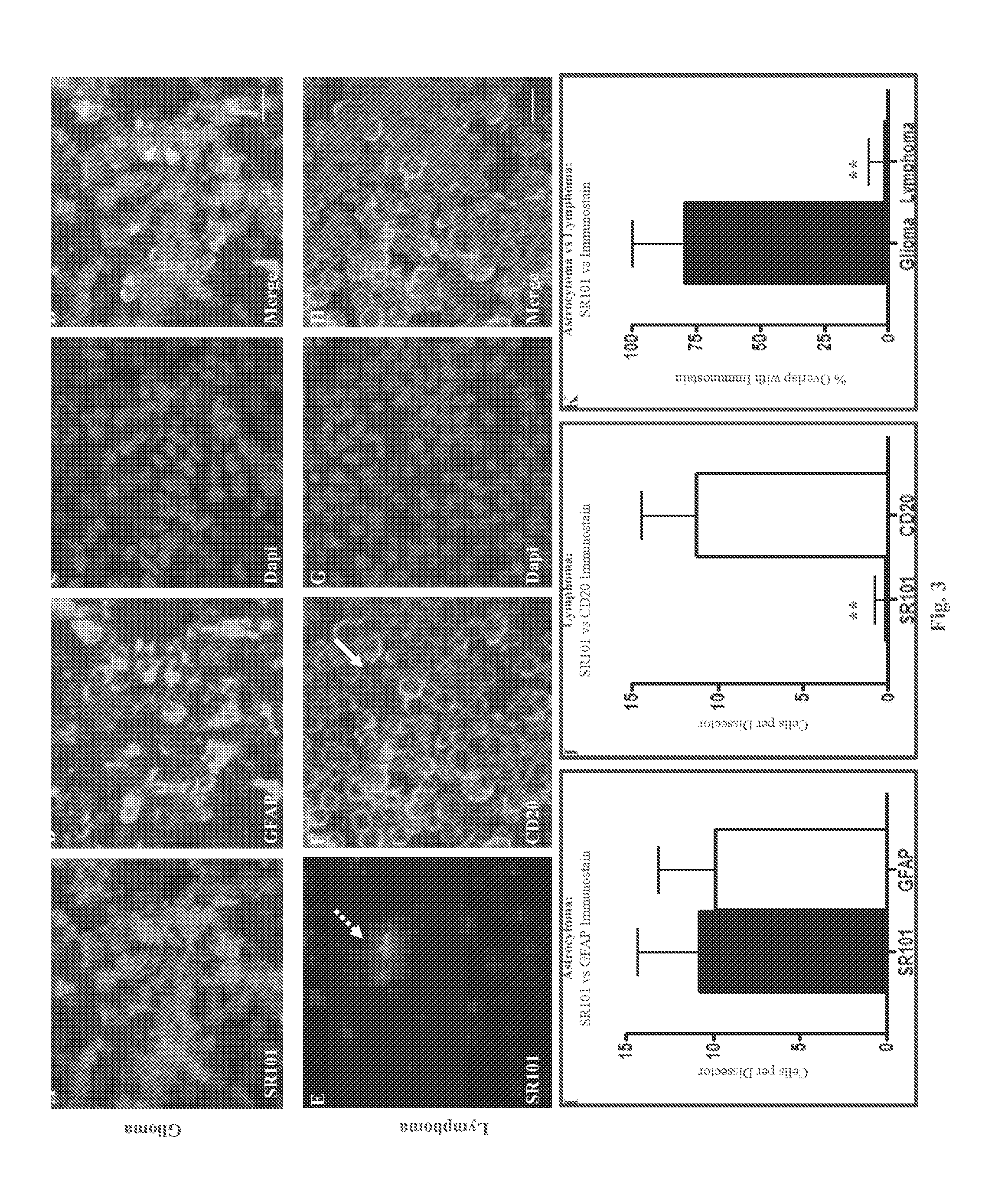 System and Method for Diagnosis of Astrocytic Brain Tumor