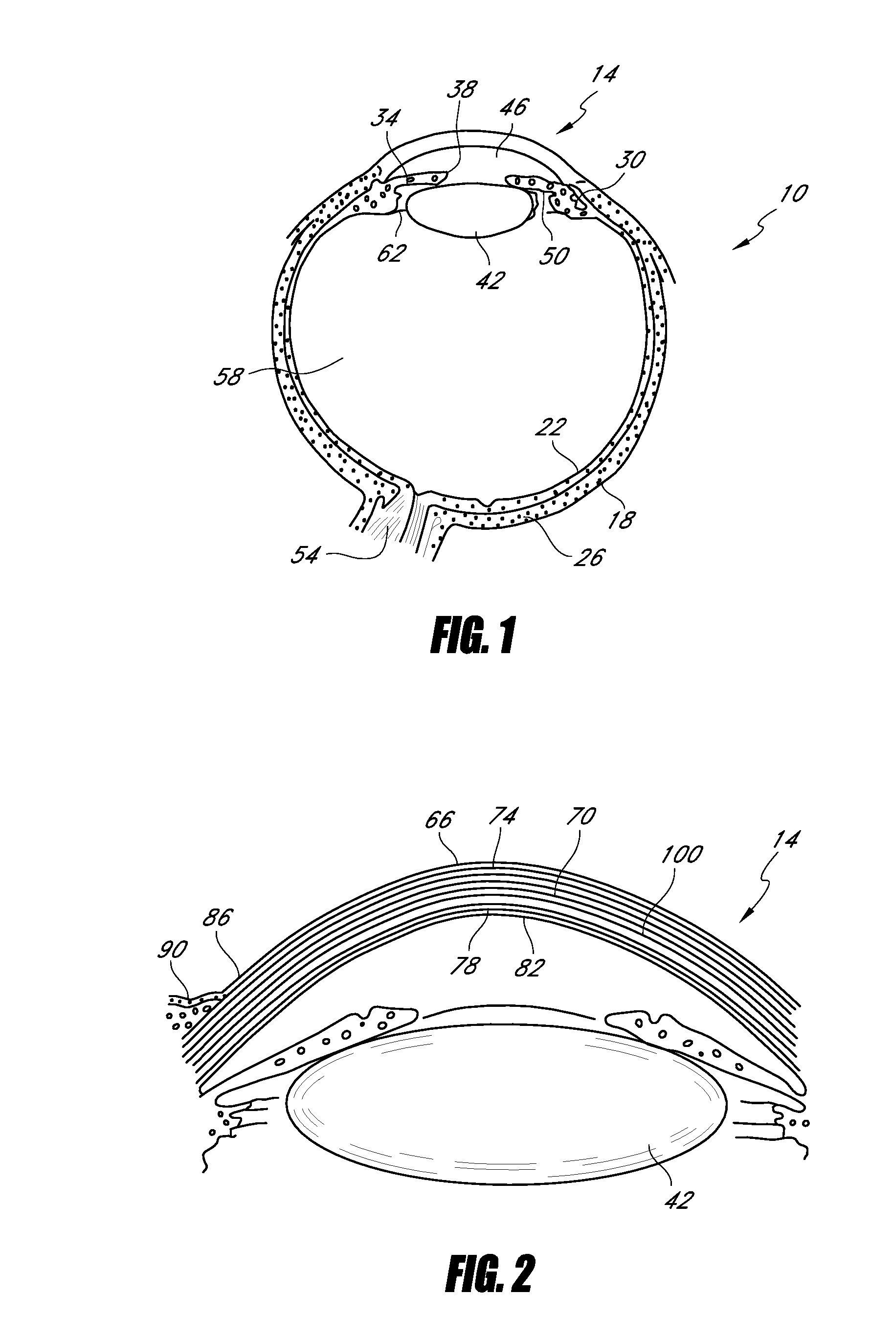 Corneal implant for refractive correction