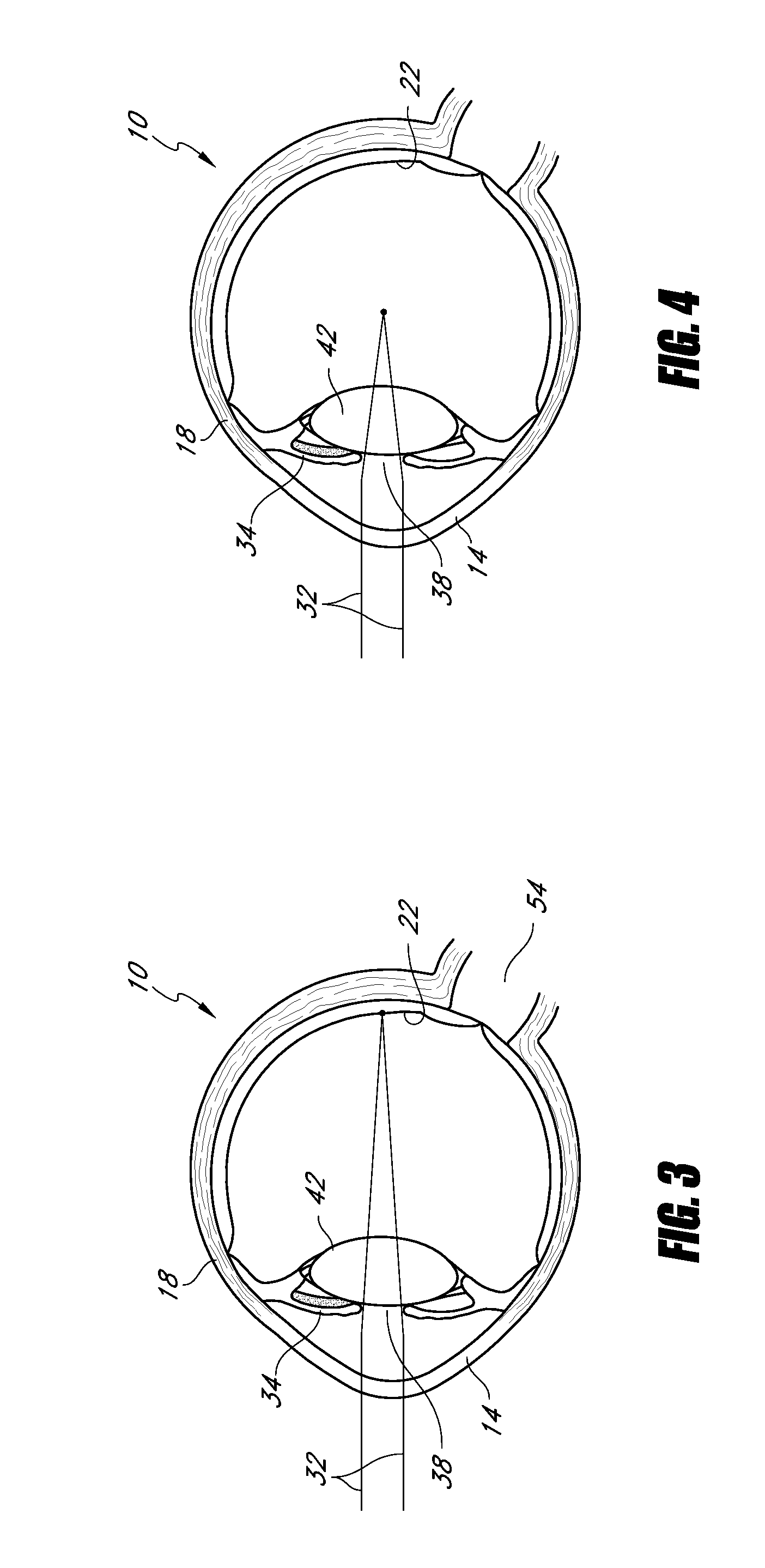 Corneal implant for refractive correction