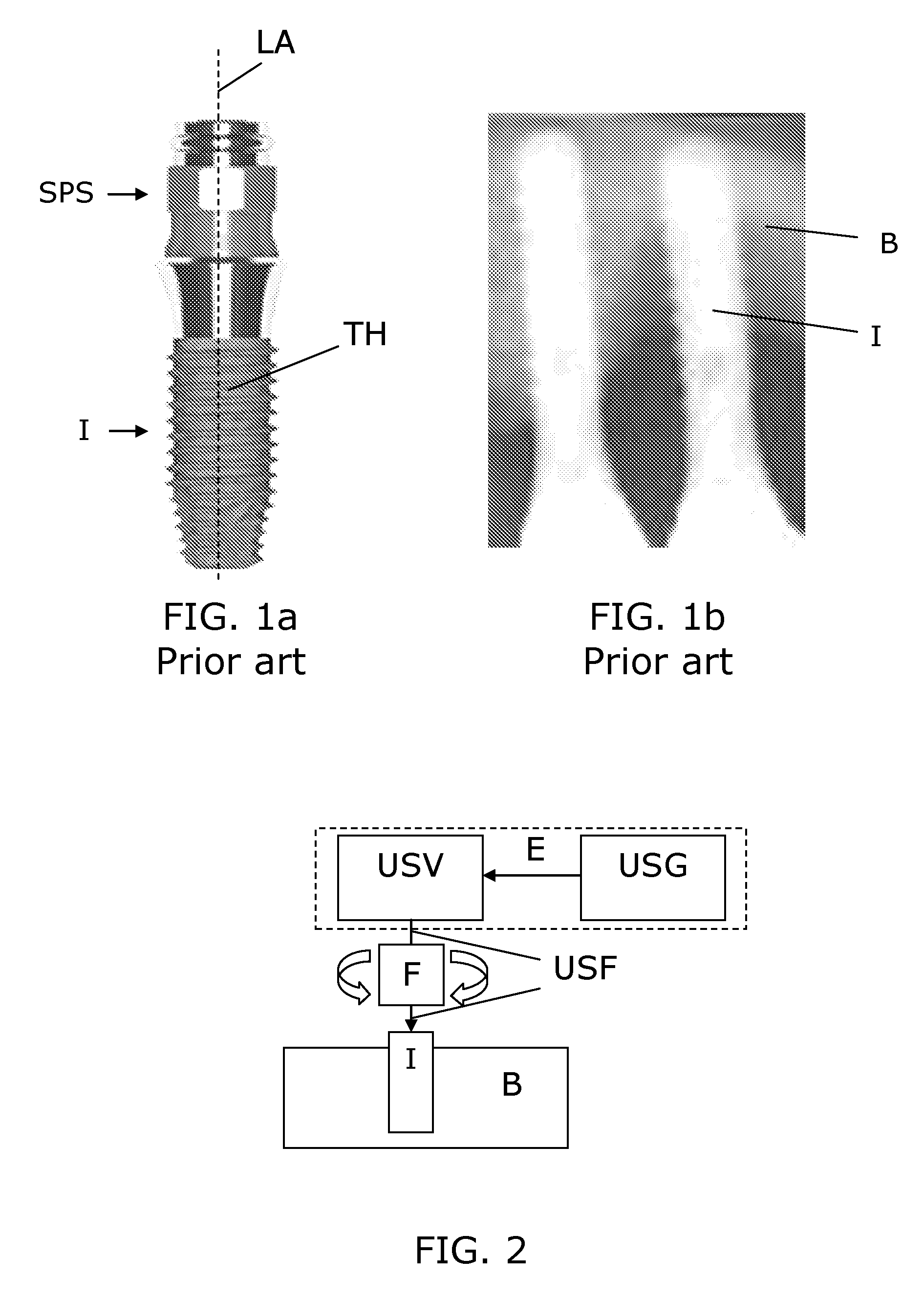 Device for loosening, insertion and removal of dental implants