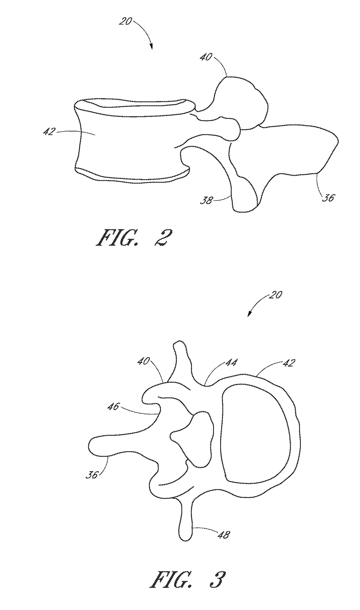 Devices and methods for intra-operative spinal alignment