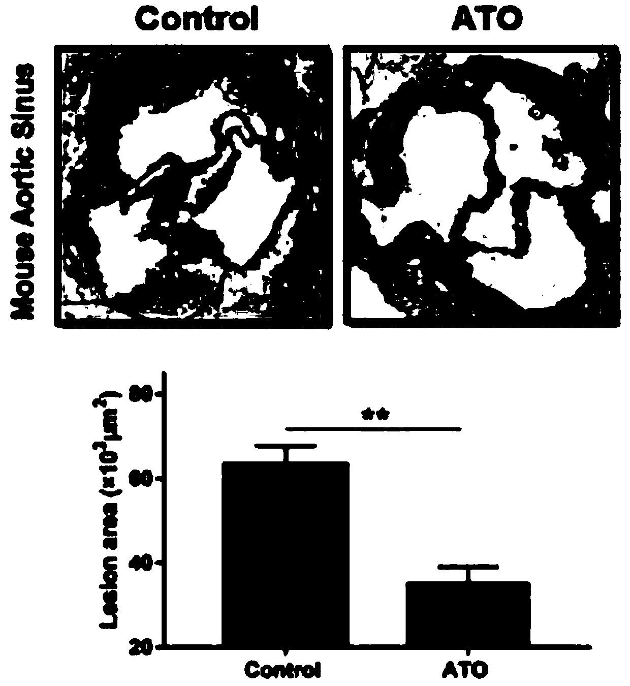 Use of arsenic trioxide in preparation of medicines for treating advanced atherosclerosis