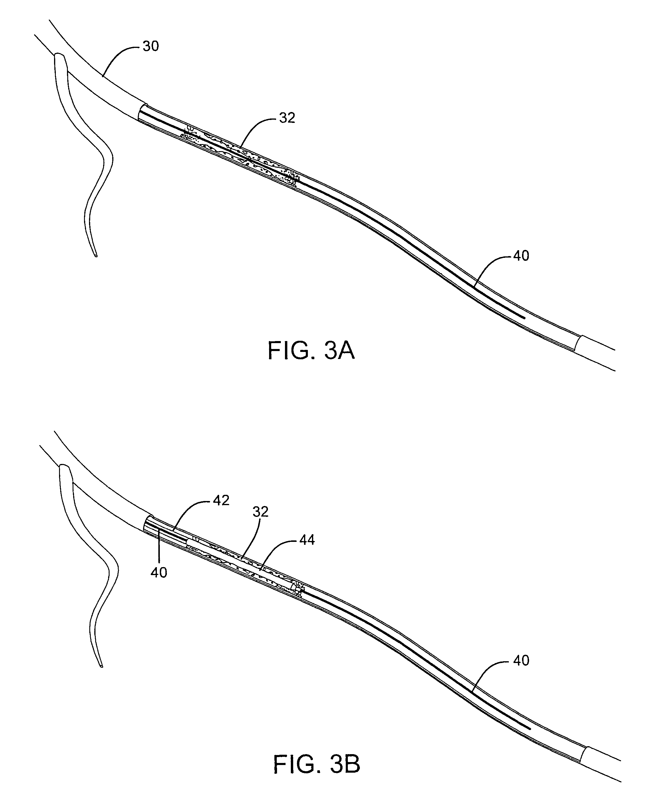 Corewire actuated delivery system with fixed distal stent-carrying extension