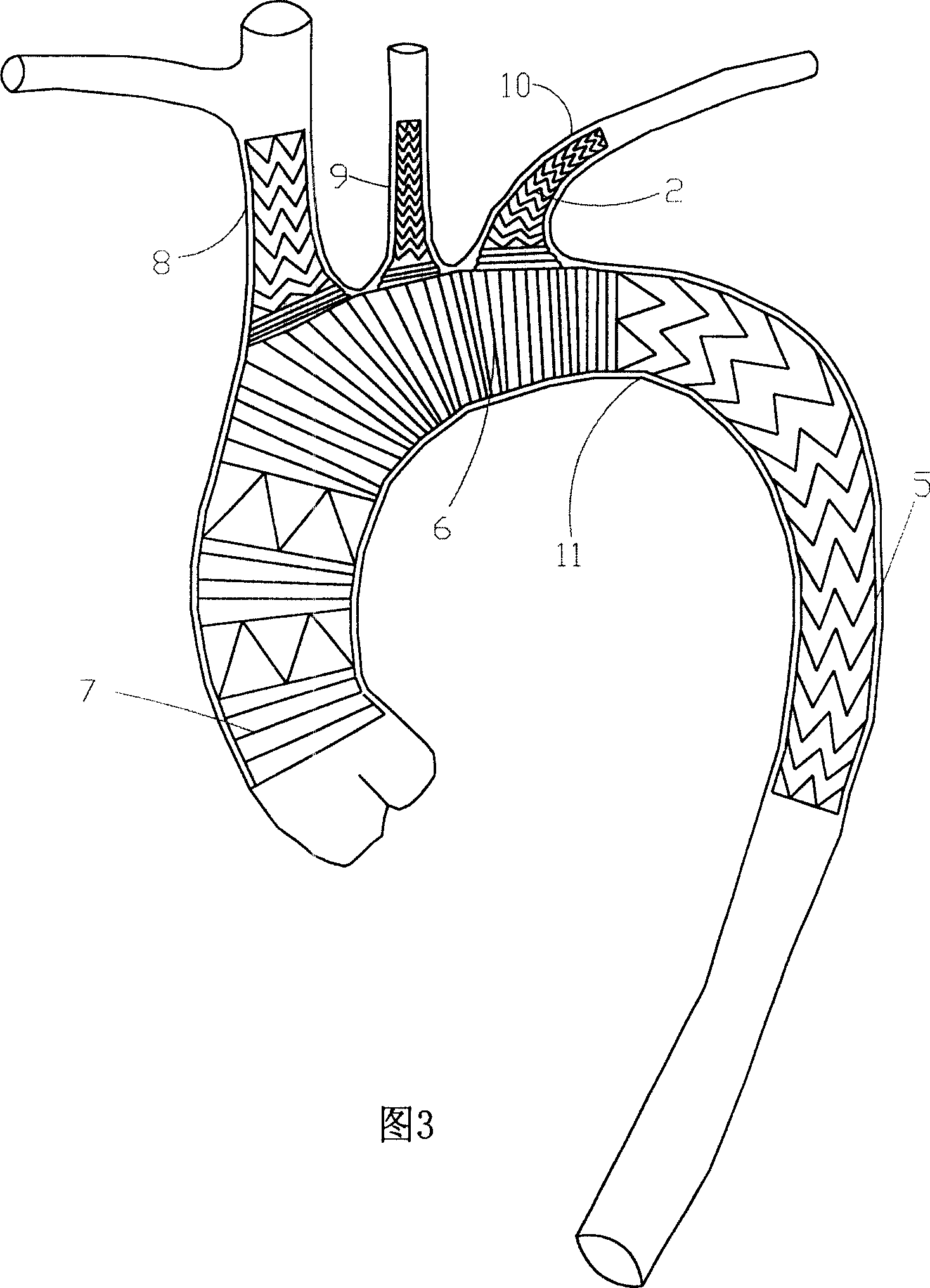 Three-collateral bracket vascellum for arcus aortae