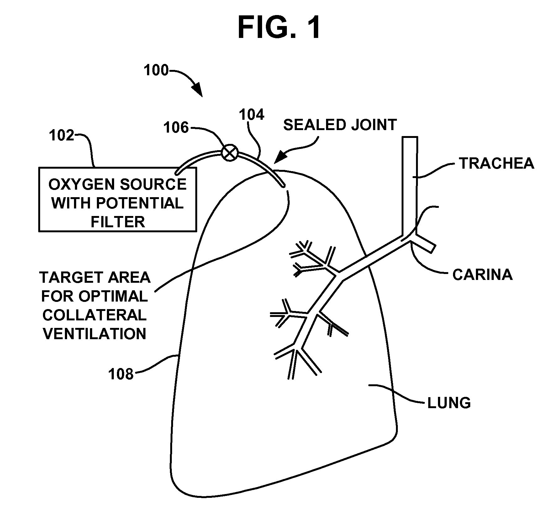 Device and method for creating a localized pleurodesis and treating a lung through the localized pleurodesis
