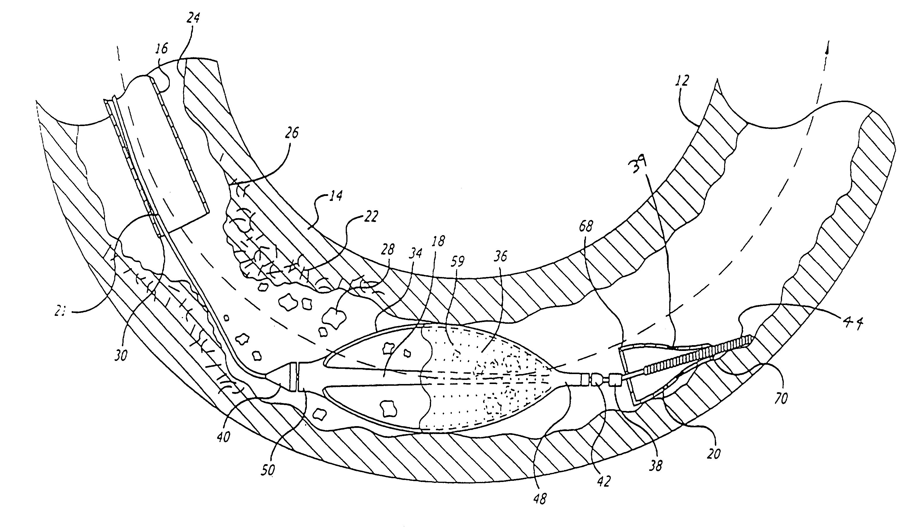 Hinged short cage for an embolic protection device