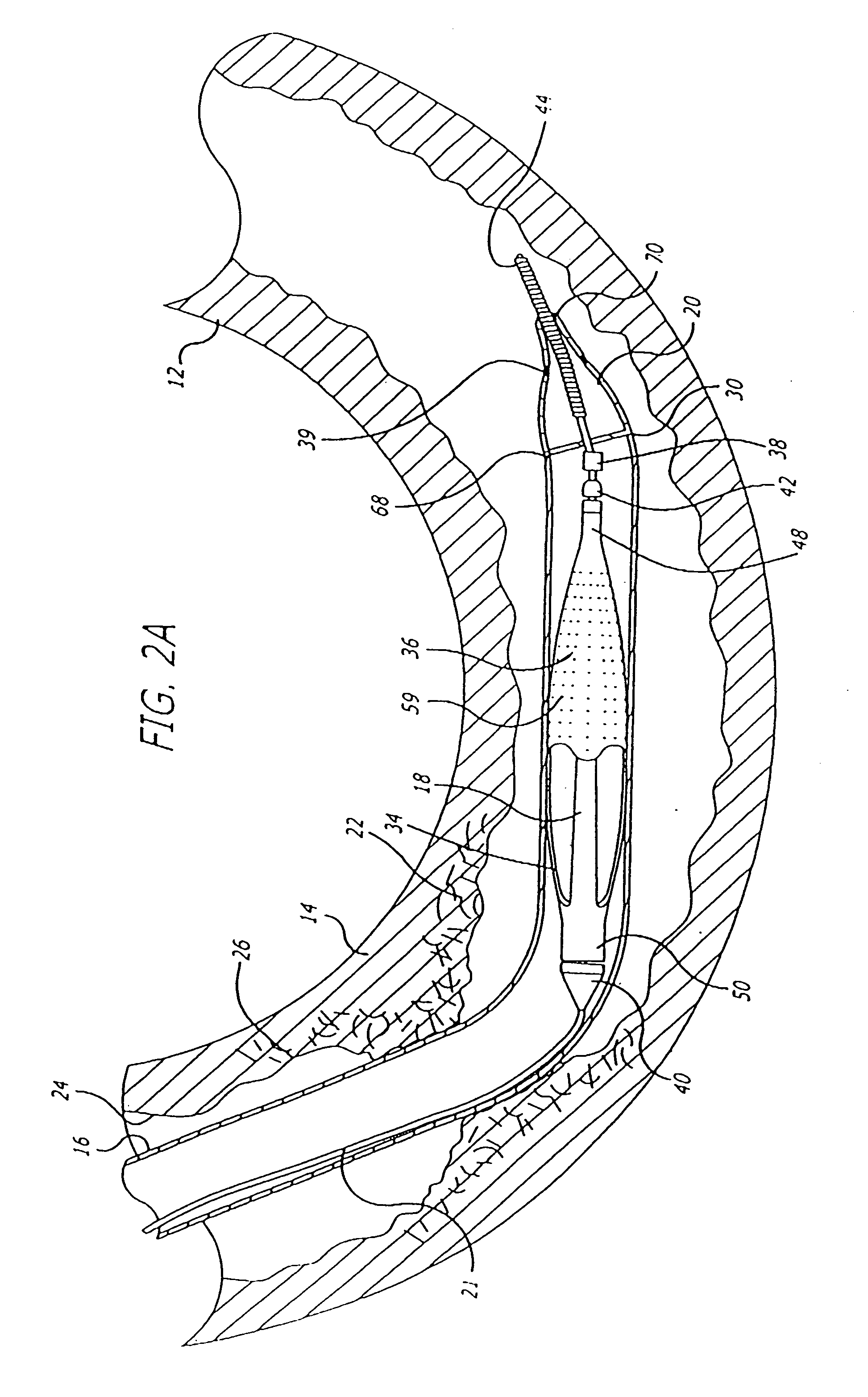 Hinged short cage for an embolic protection device