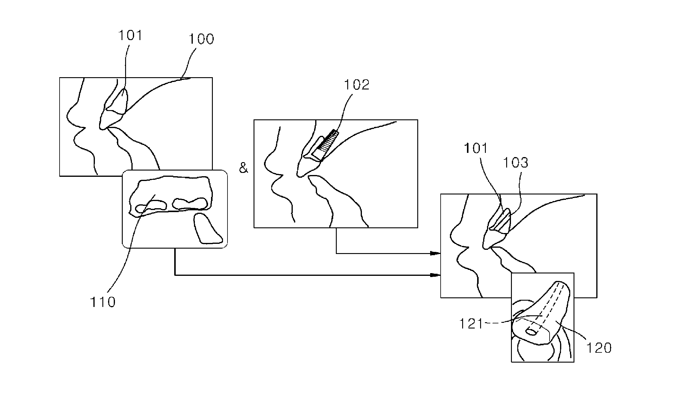 Method of manufacturing scaffold for treatment of tooth extraction socket and implantation of dental implant