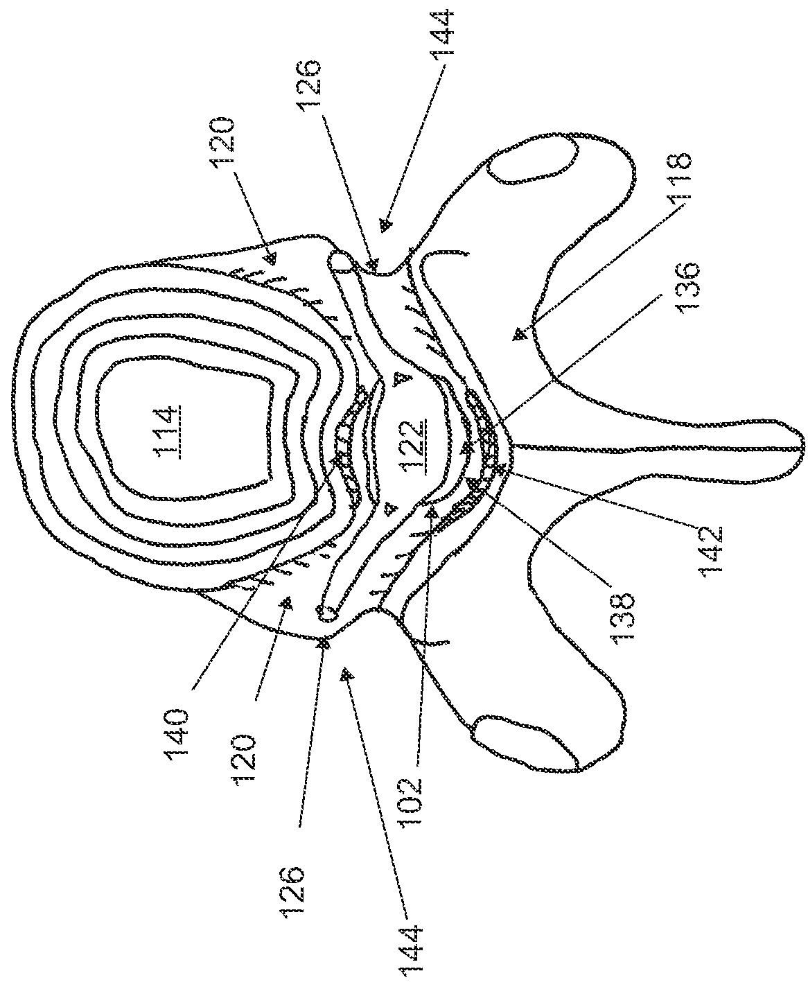 Method and devices for treating spinal stenosis