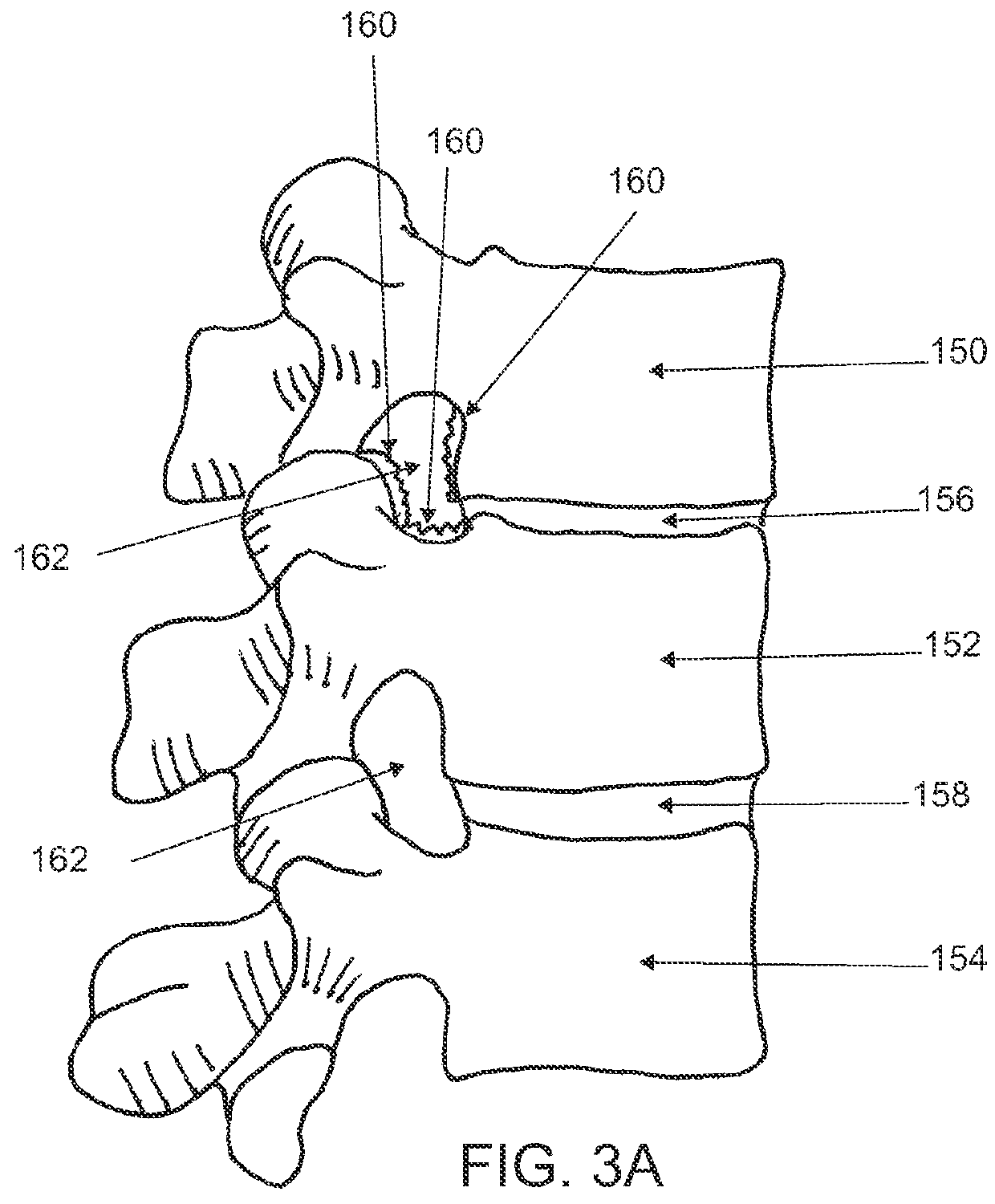 Method and devices for treating spinal stenosis