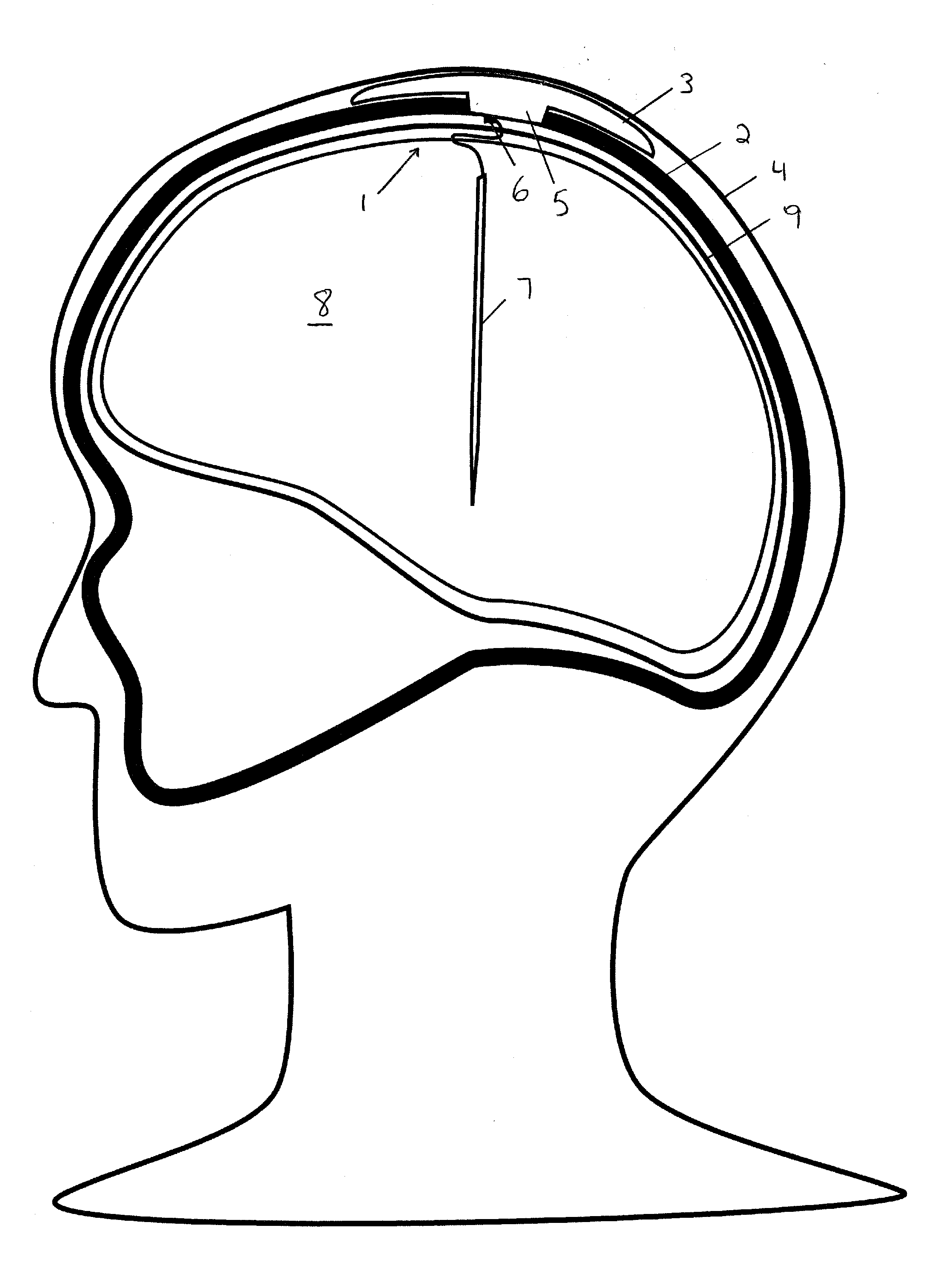 Implantable transcranial pulse generator having a collapsible portion