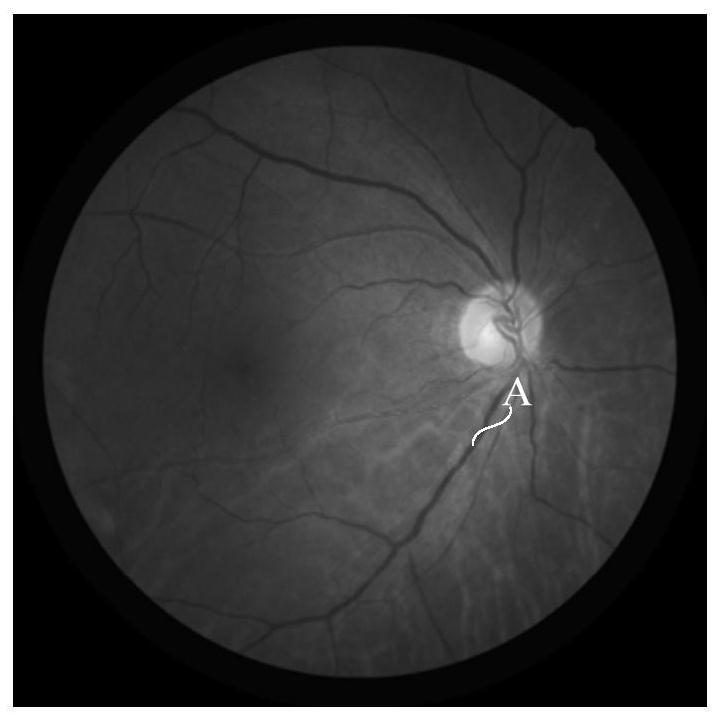 Method and system for measuring lesion characteristics of hypertensive retinopathy
