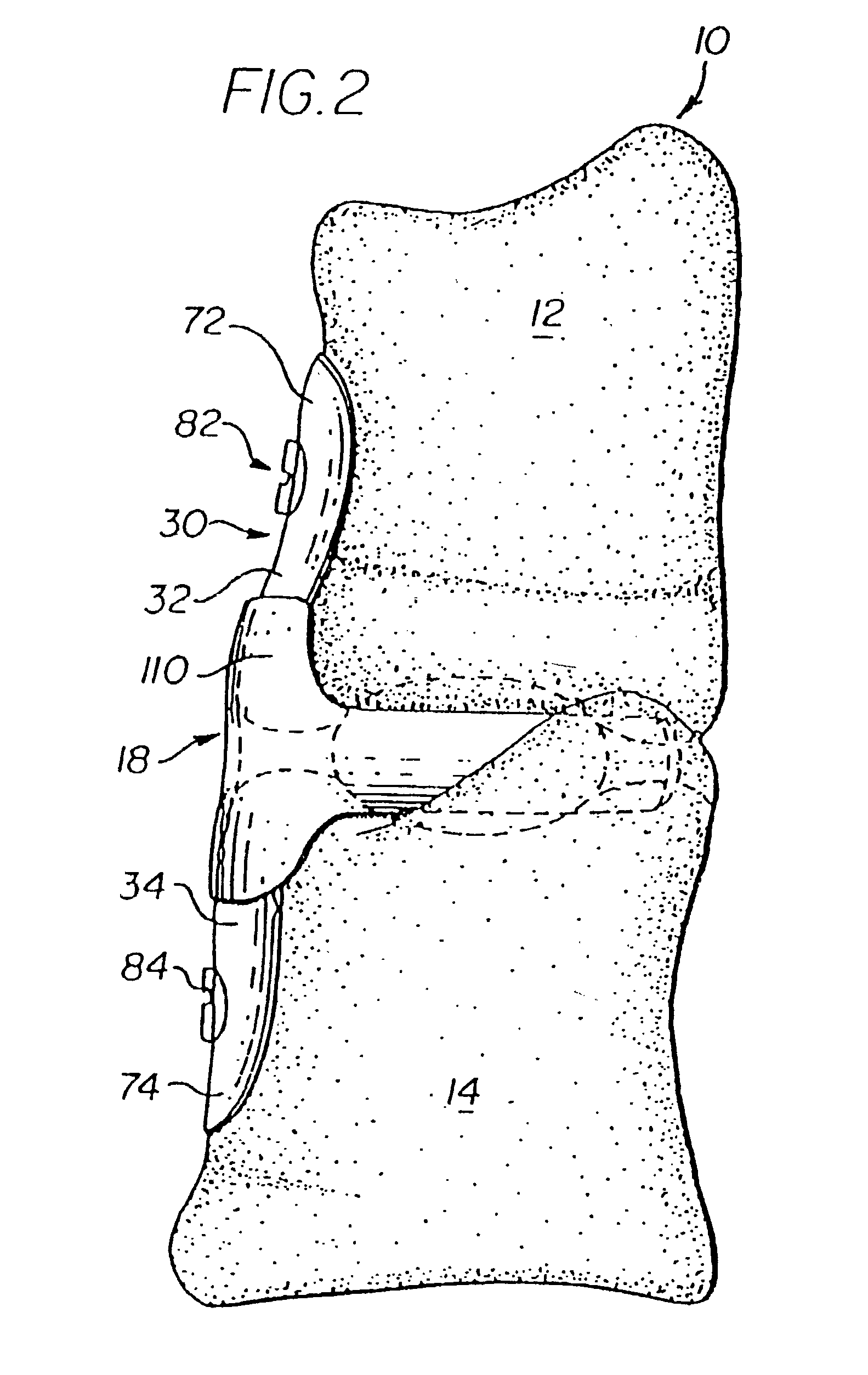 Human spinal disc prothesis with hinges