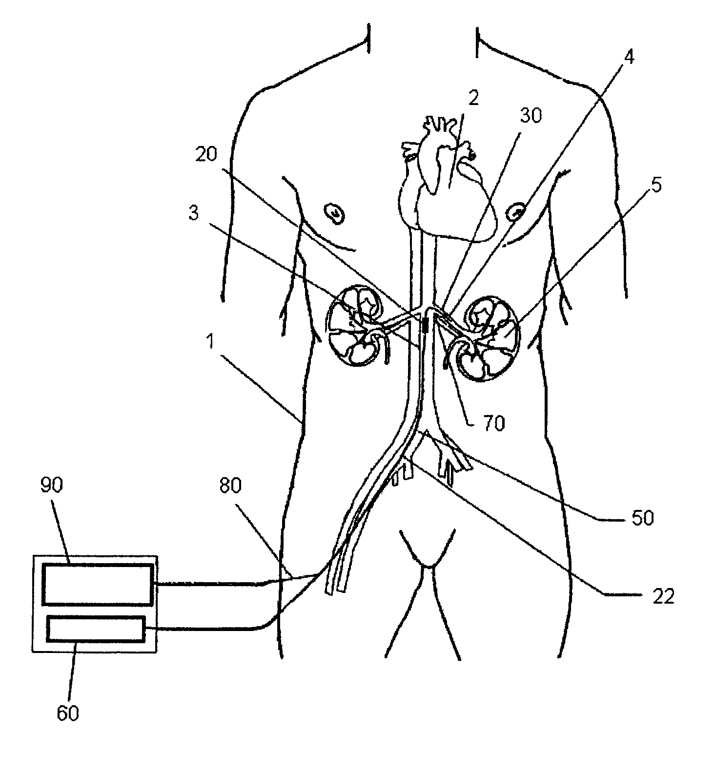 Method and apparatus for treatment of congestive heart disease