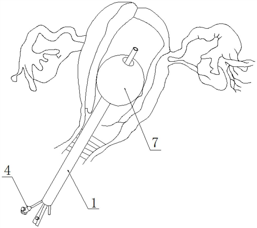 Hemostasis bulb tube assembly and postpartum hemostasis equipment