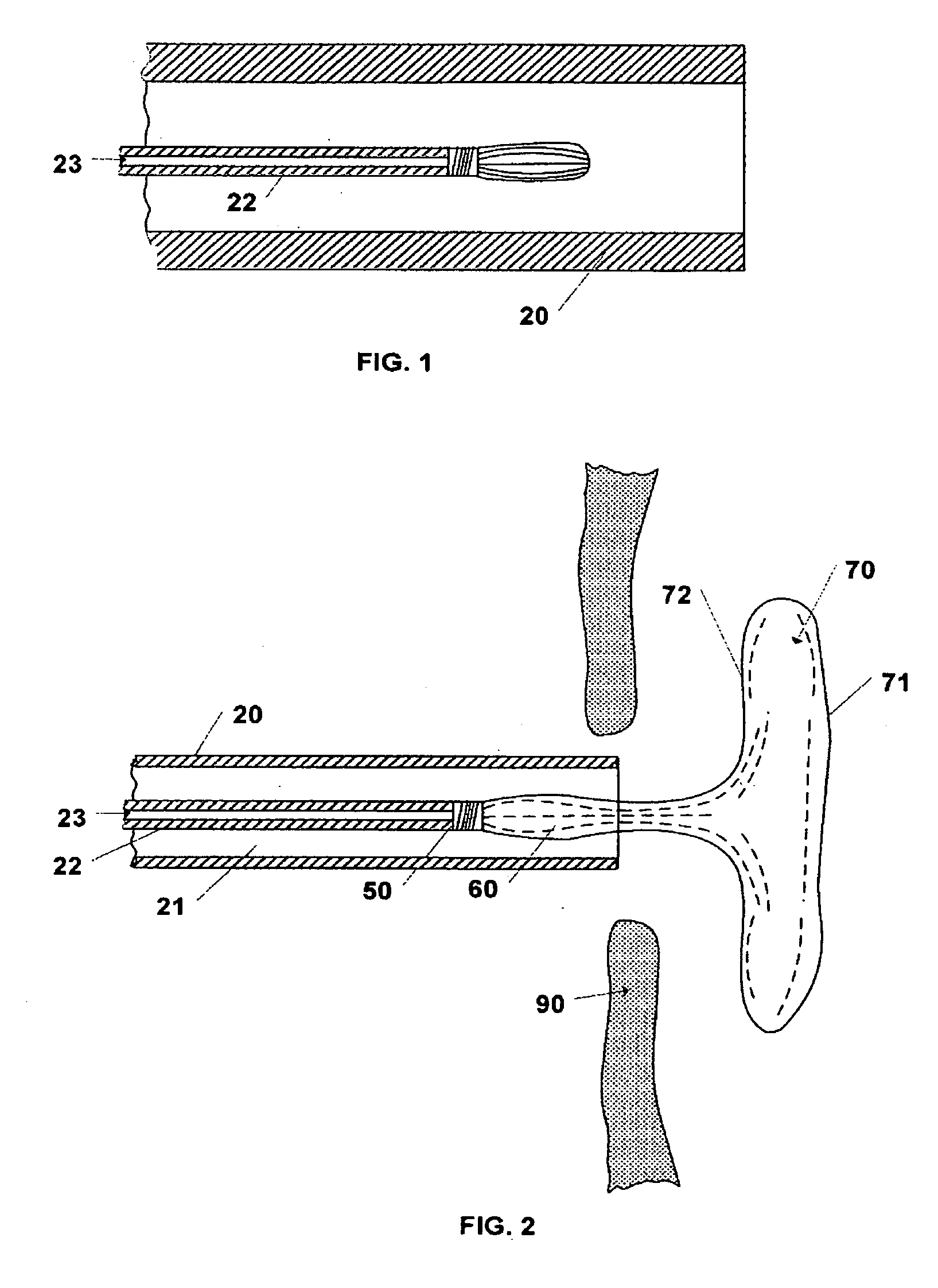 Device and Method for Closure of Atrial Septal Defects