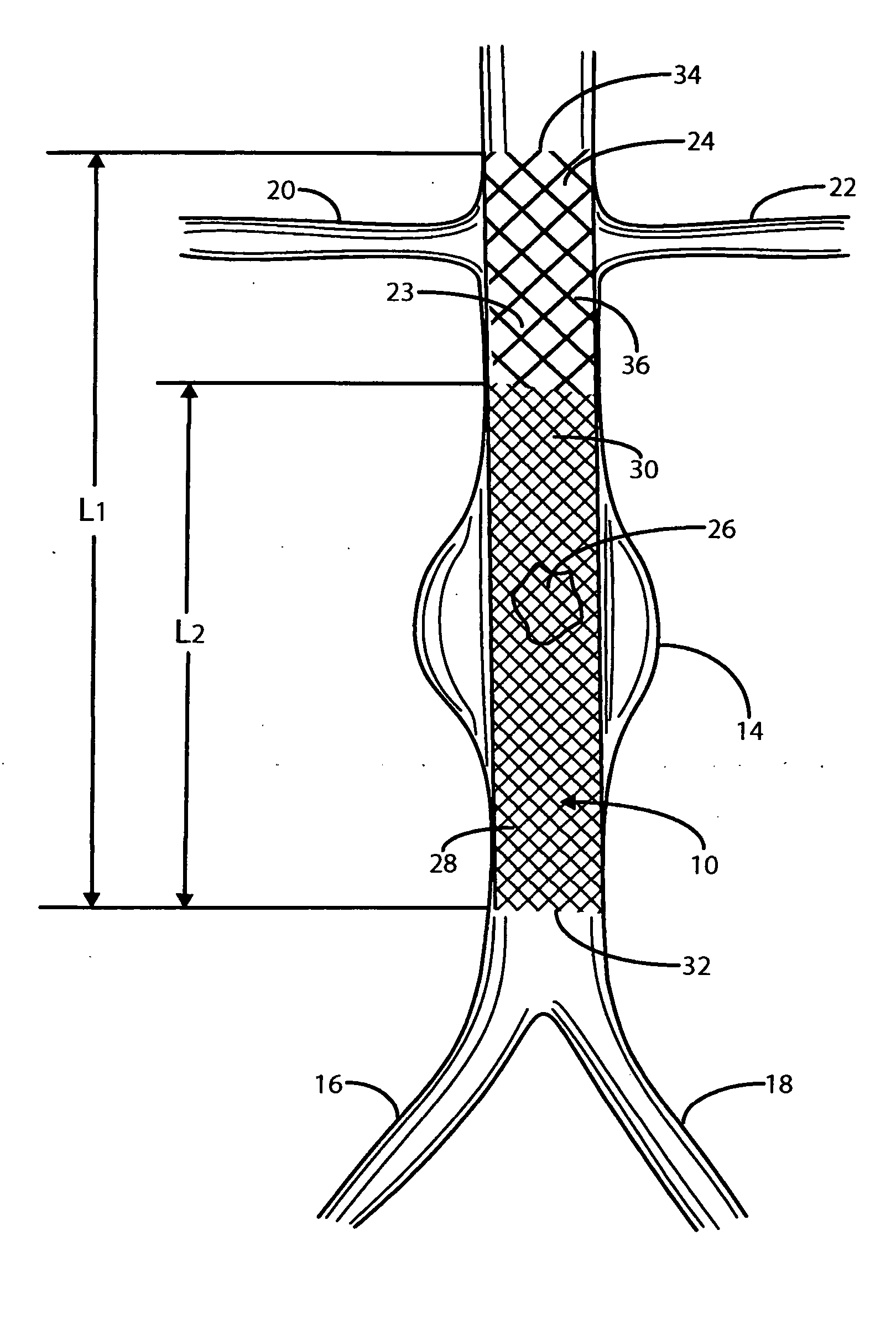 Intravascular deliverable stent for reinforcement of abdominal aortic aneurysm