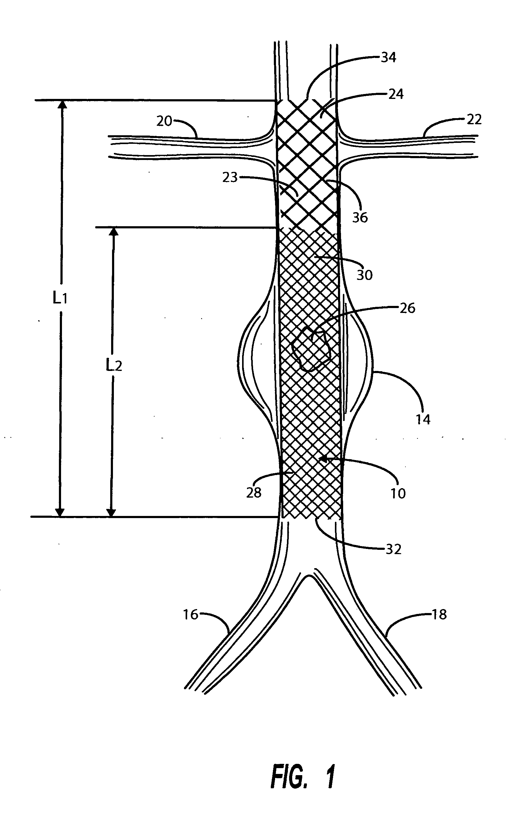 Intravascular deliverable stent for reinforcement of abdominal aortic aneurysm
