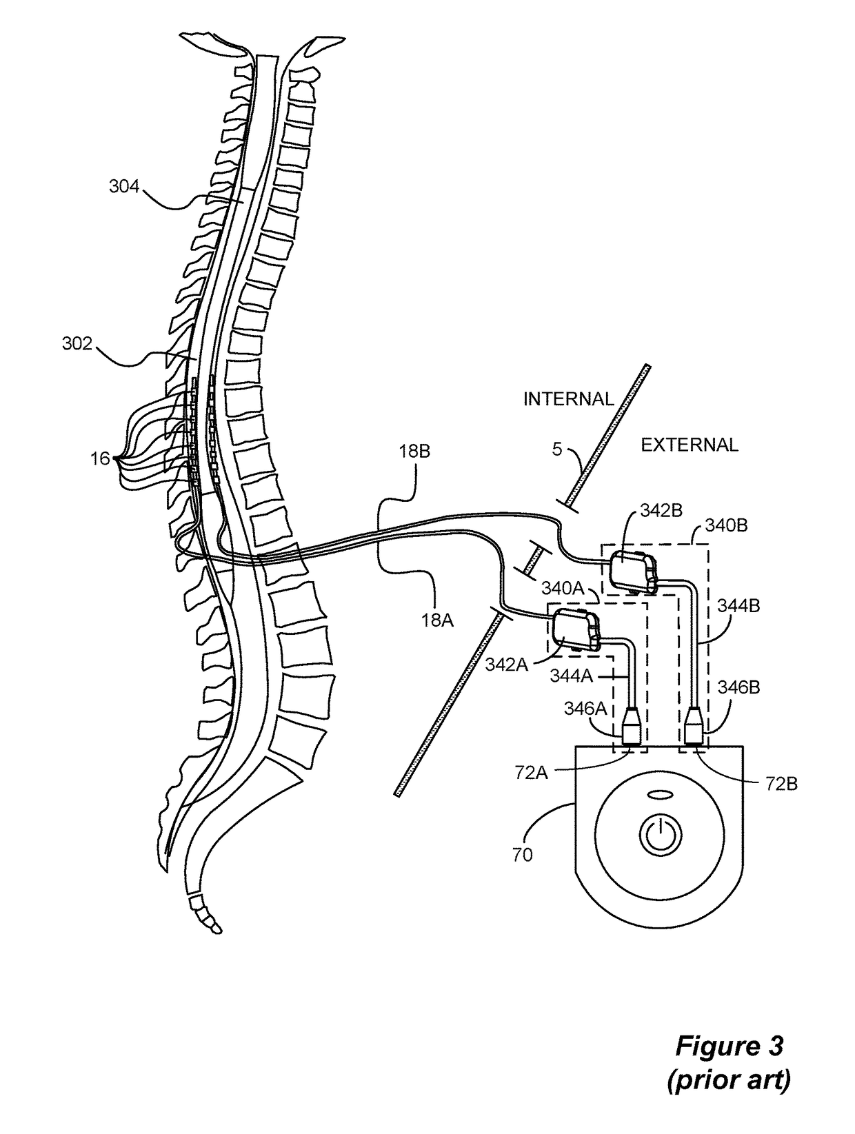System to Estimate the Location of a Spinal Cord Physiological Midline