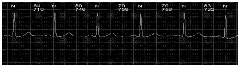 Method and system for analyzing electrocardiogram data