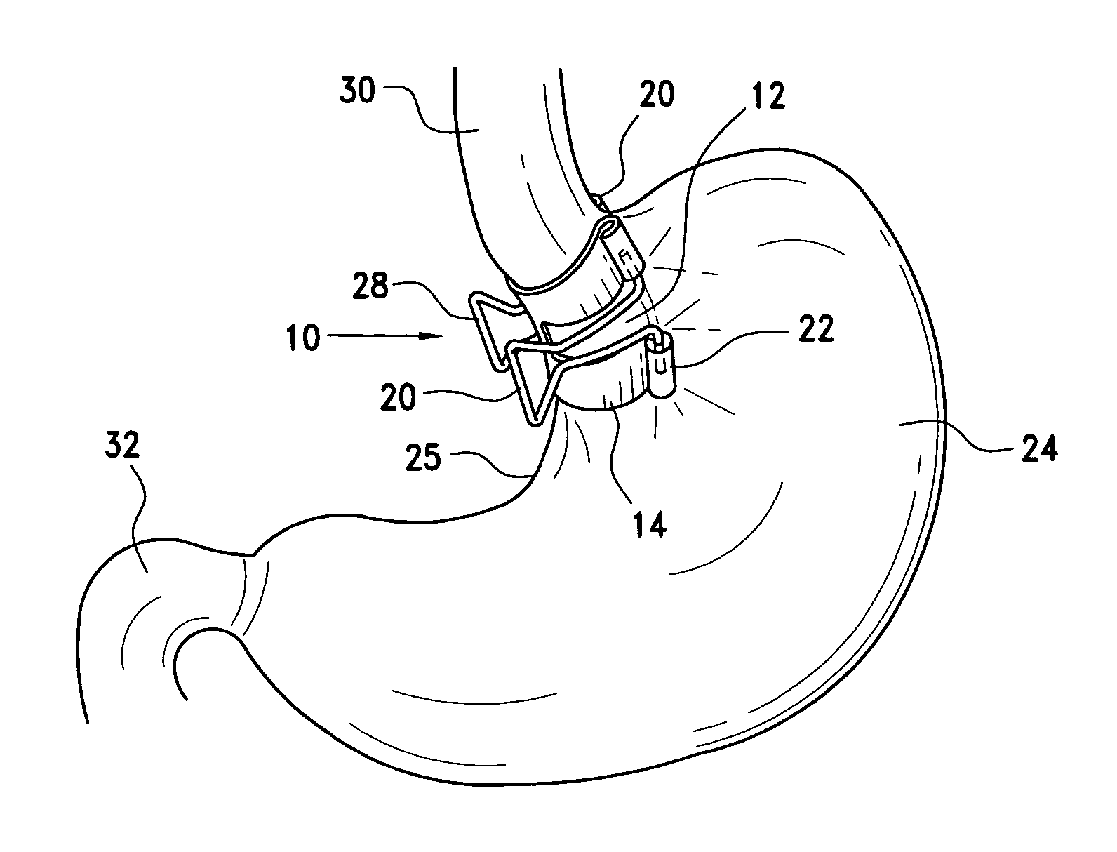 Method and clamp for gastric reduction surgery