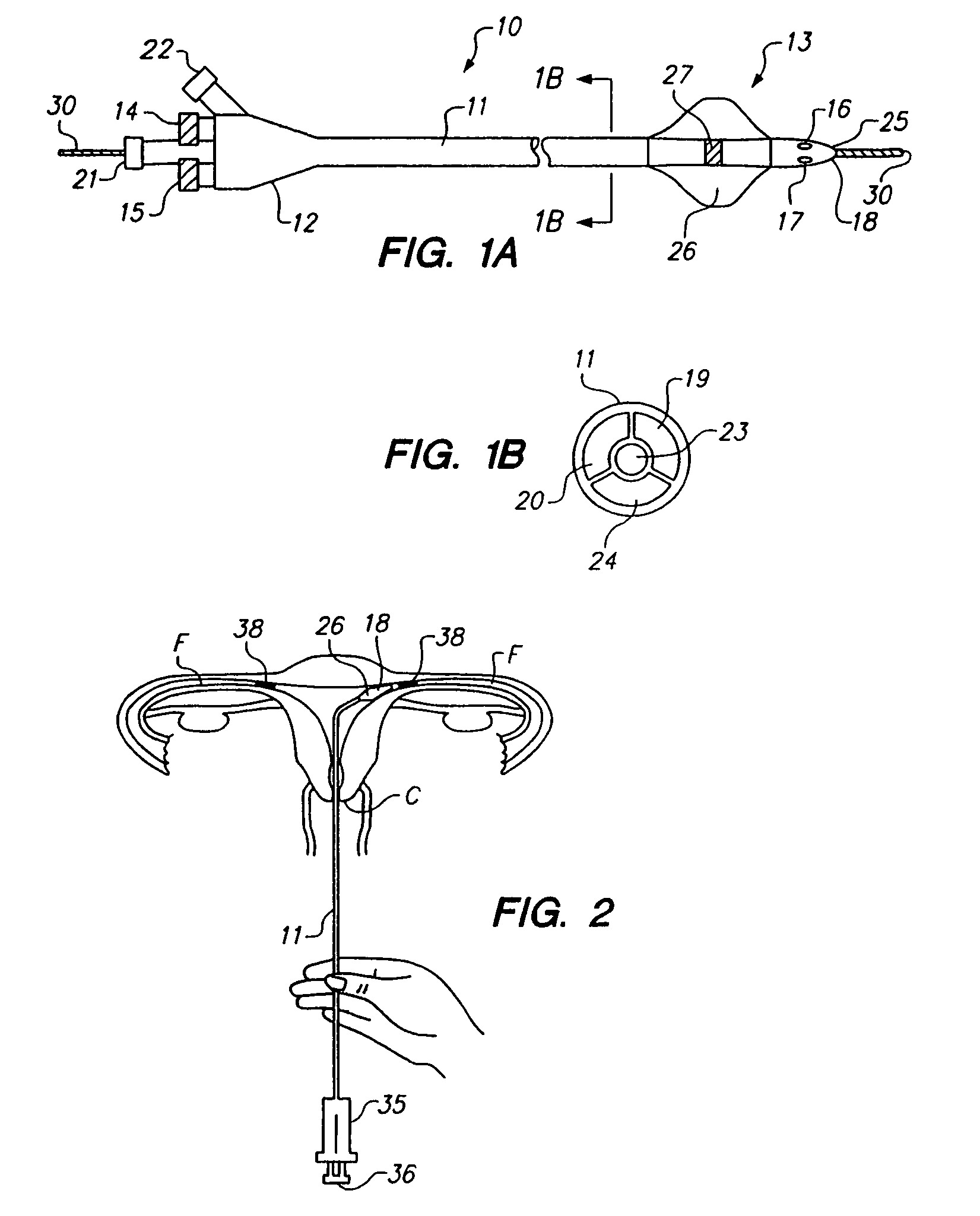 Methods and apparatus for intraluminal deposition of hydrogels
