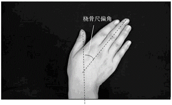 Hand function rehabilitation quantitative evaluation method based on hand ulnar deviation motion