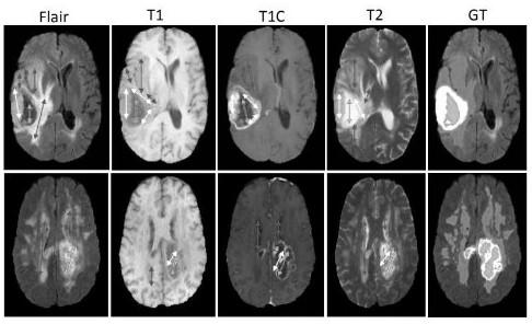 Brain tumor segmentation method based on multi-level structure relation learning network